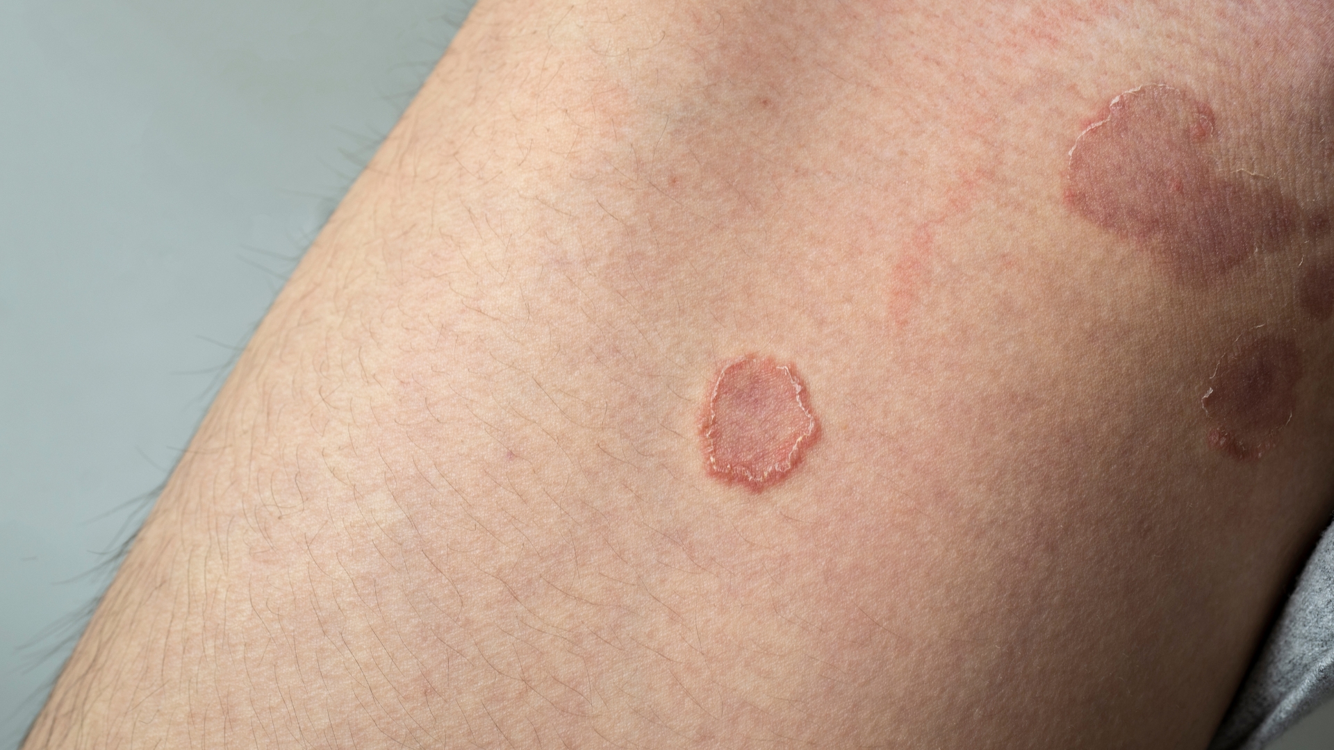 Viêm da dạng đồng tiền là một bệnh lý lành tính có thể có các biểu hiện tương tự