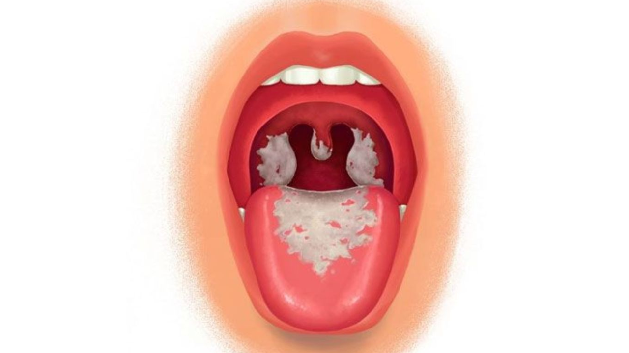 Cơ chế gây bệnh của vi khuẩn bạch hầu