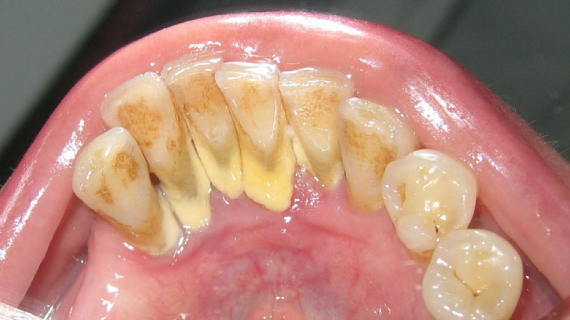 Vi khuẩn kết hợp vụn thức ăn tạo mảng bám, bám chặt men răng mỗi ngày