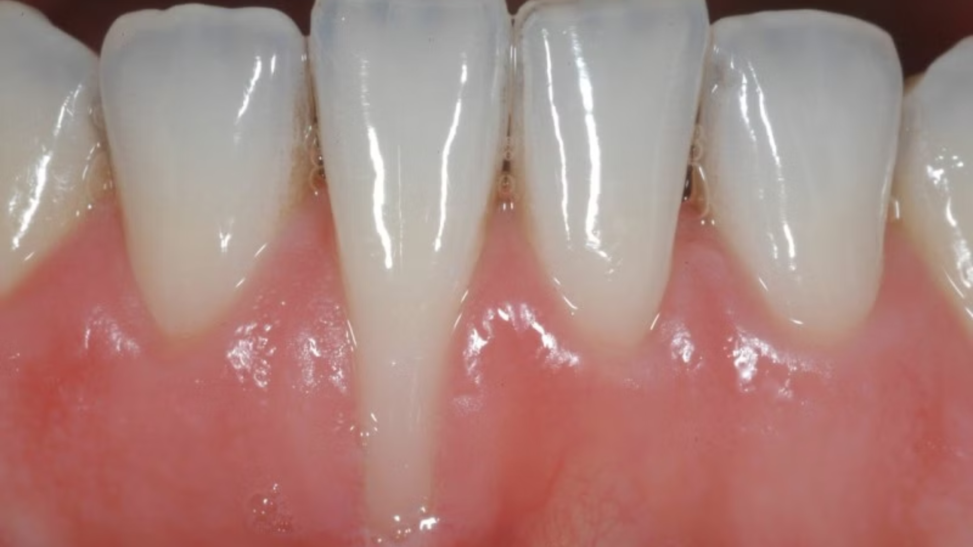 Actinomyces thường gây sâu răng vùng chân răng, nhất là khi tụt lợi kéo dài