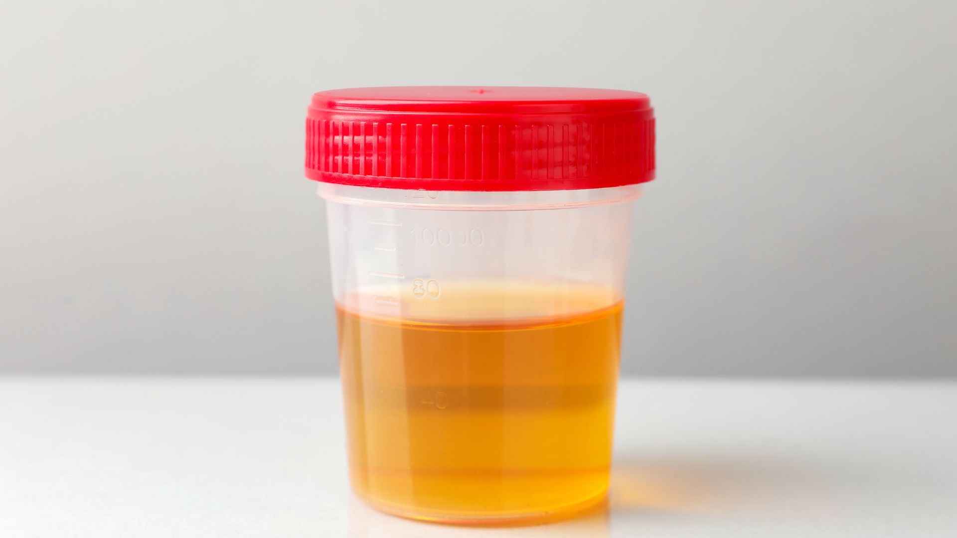 Nước tiểu là một trong các mẫu bệnh phẩm của xét nghiệm vi khuẩn nhuộm soi