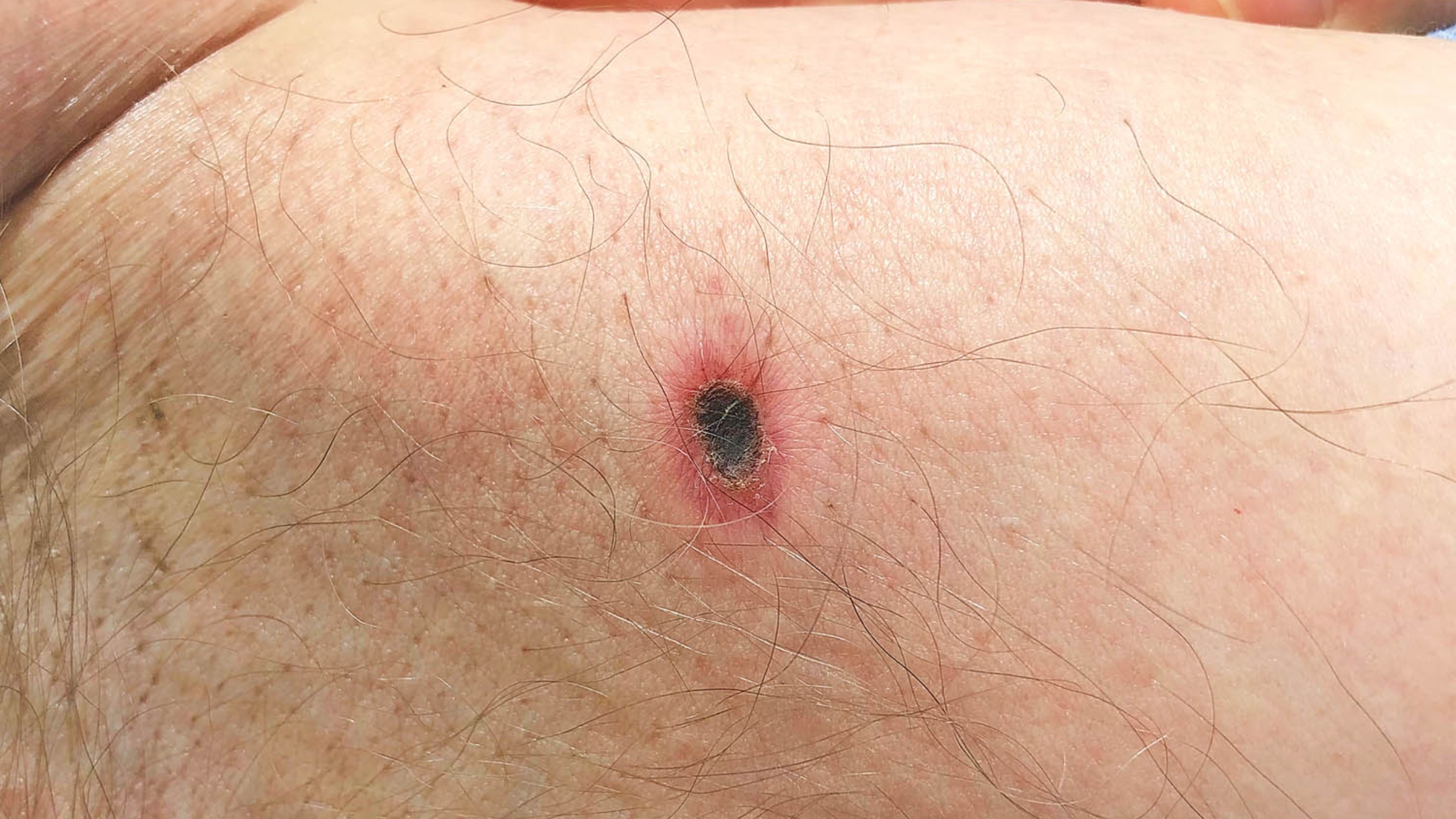 Tại vị trí tổn thương ban đầu xuất hiện một nốt phỏng nhỏ, sau đó tiến triển thành vết loét đặc trưng