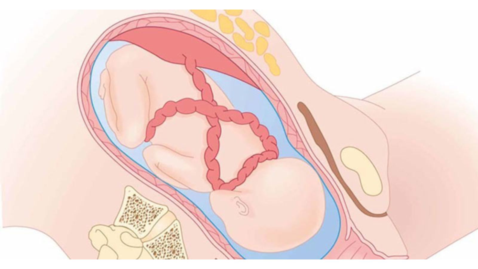 Không có bằng chứng khoa học chứng minh việc bà bầu với tay cao làm tăng nguy cơ dây rốn quấn cổ thai nhi