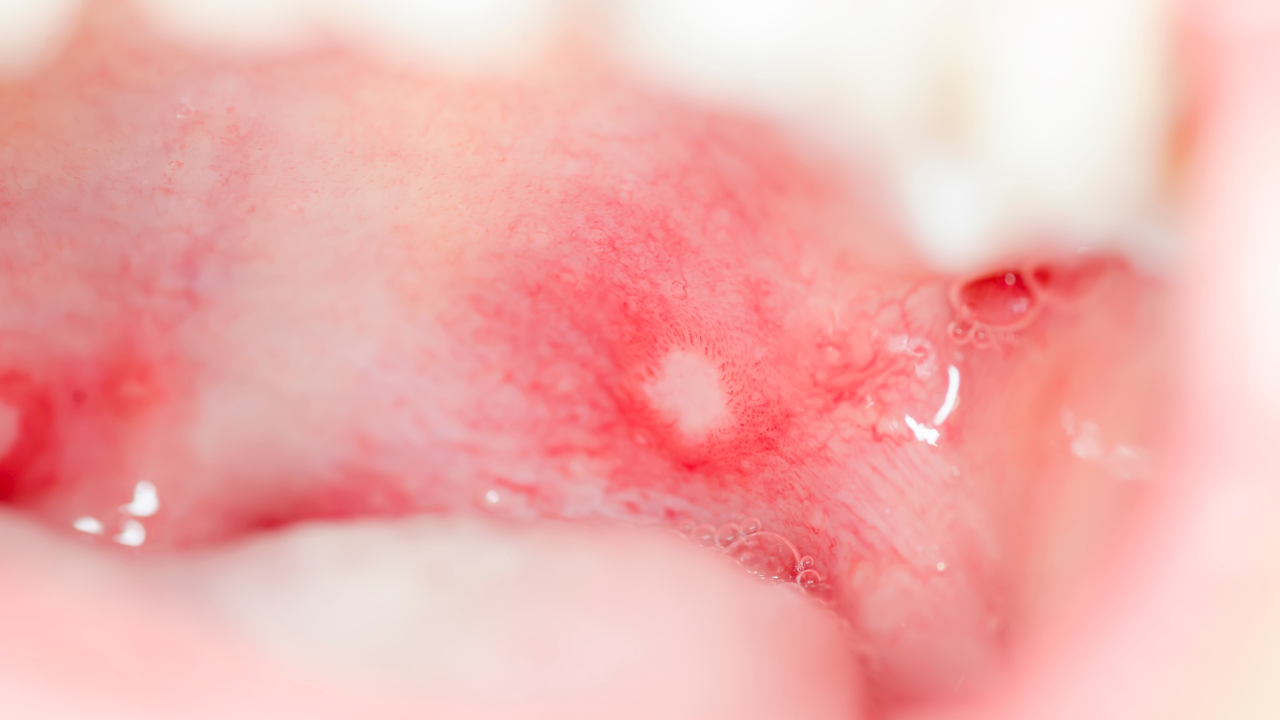 Các sản phẩm chăm sóc răng miệng chứa cồn, chất tẩy mạnh có thể gây loét miệng bên trong má