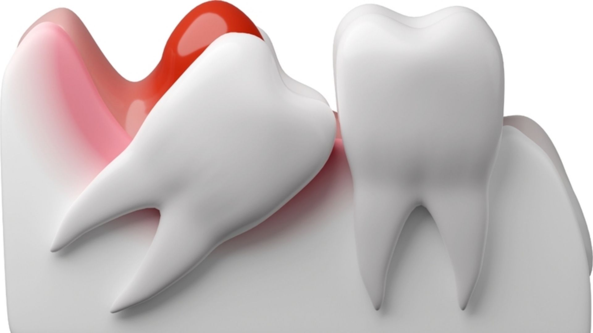 Răng khôn mọc ở tư thế bất thường gây sang chấn mô nghiêm trọng dẫn đến đau