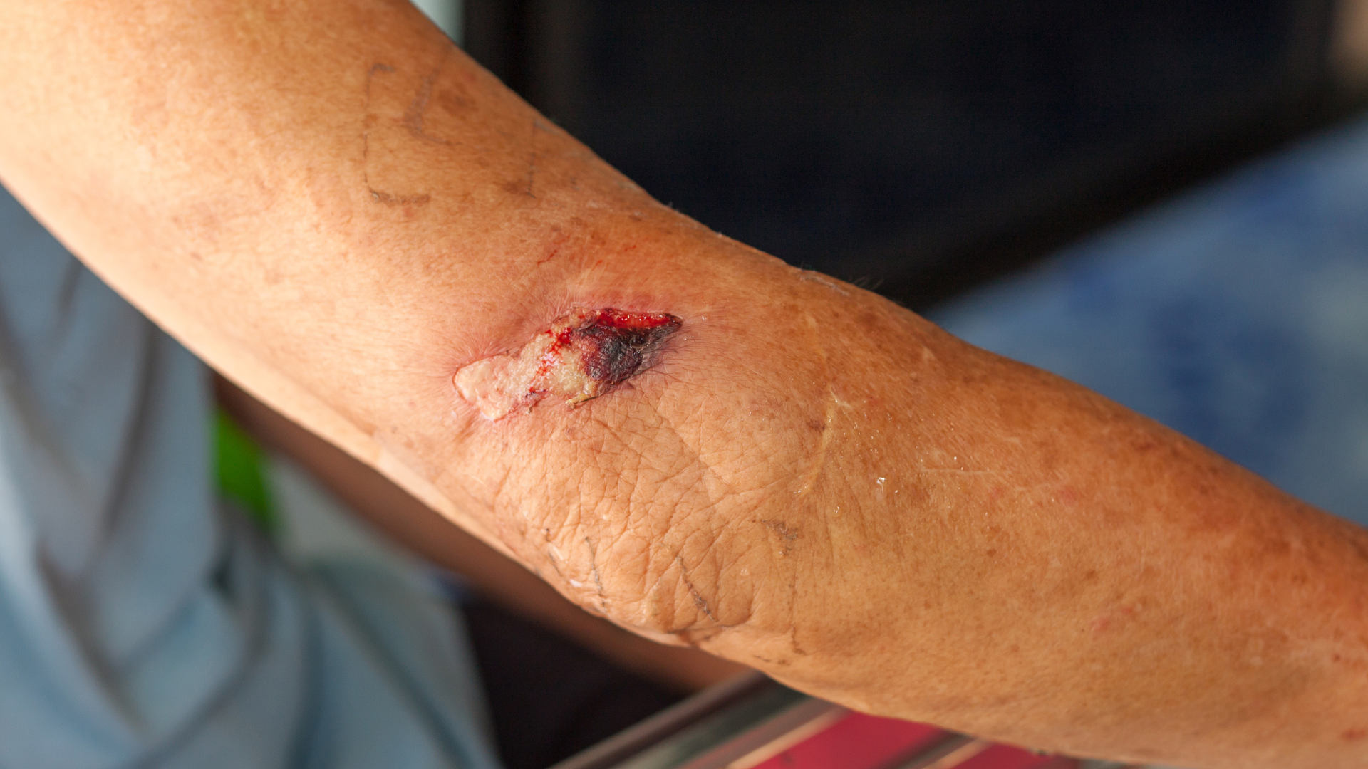 Hỗ trợ cải thiện tình trạng vì sao tiểu đường vết thương lâu lành