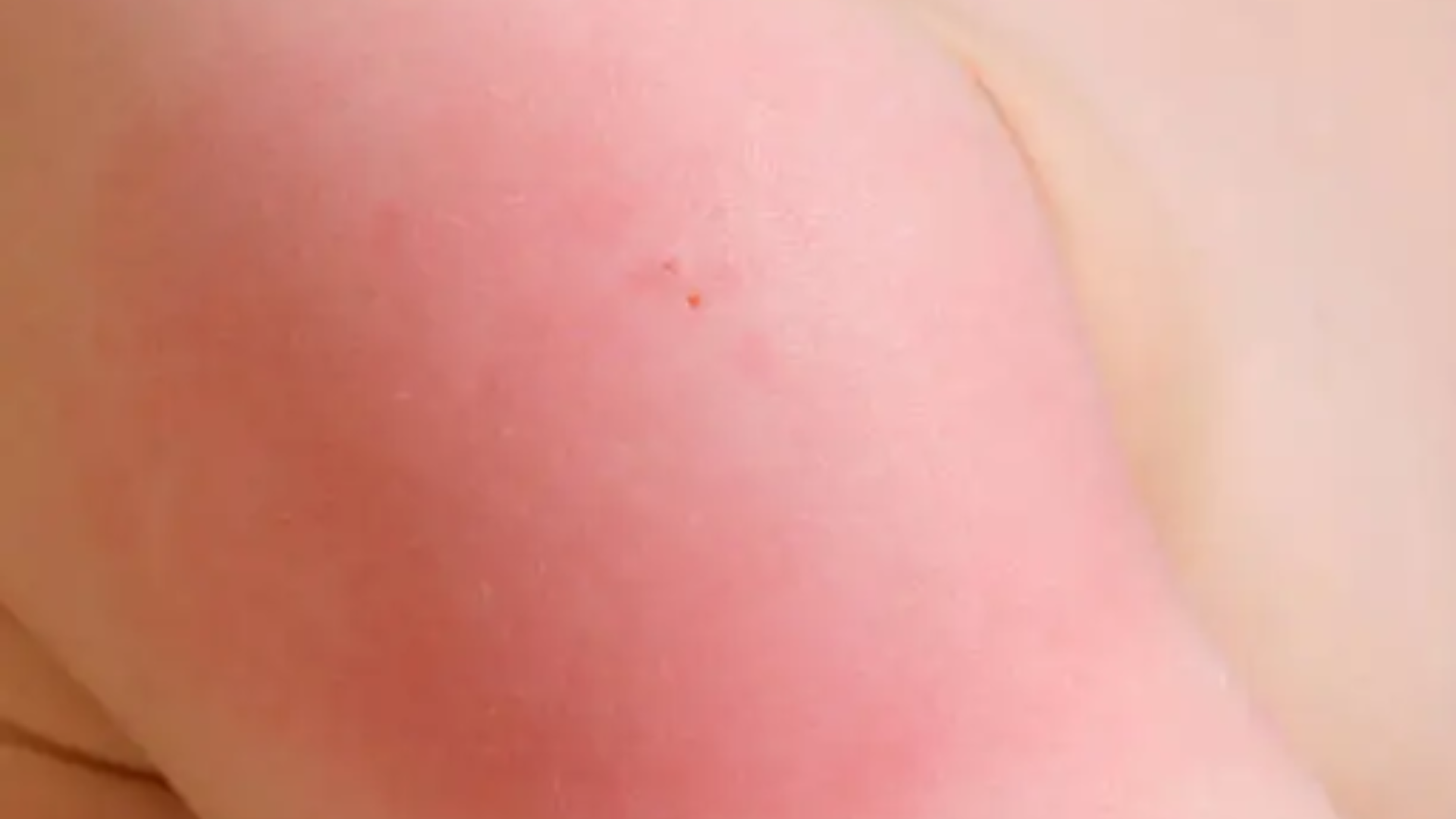 vi-sao-vet-tiem-phong-bi-sung-cung-lau-ngay-va-cach-xu-ly-hieu-qua-2