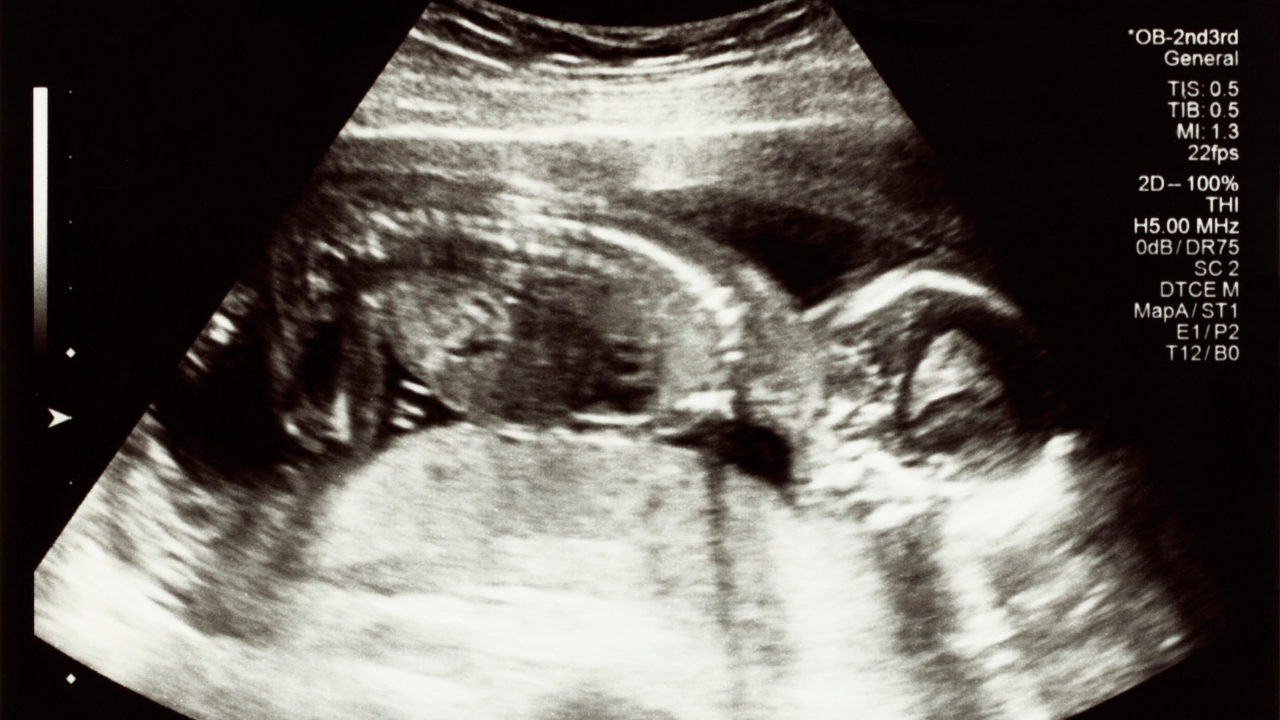 Theo dõi vị trí thai nhi trong 3 tháng giữa