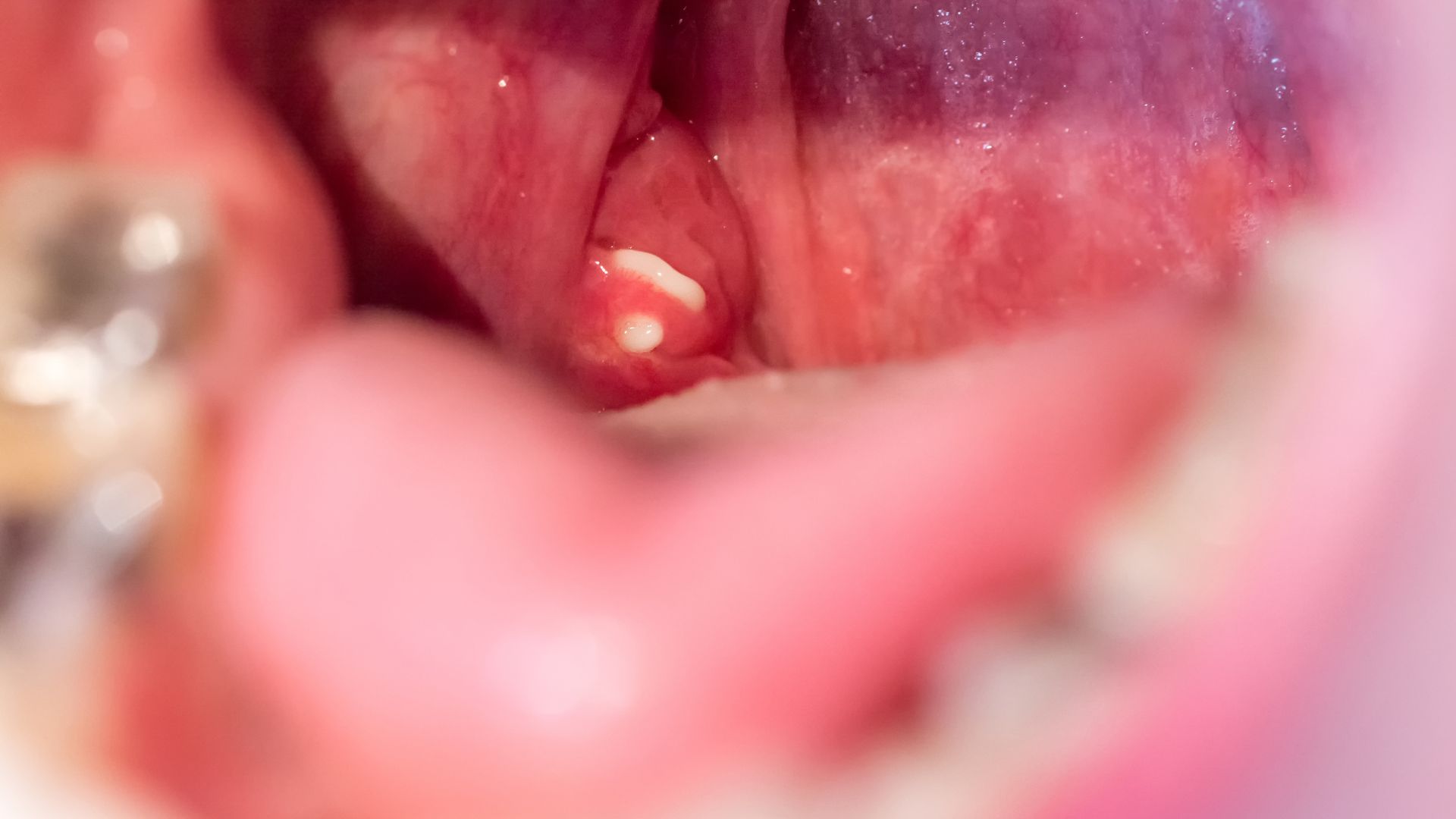 Viêm amidan hốc mủ 1 bên là tình trạng 1 bên amidan bị viêm và xuất hiện mủ