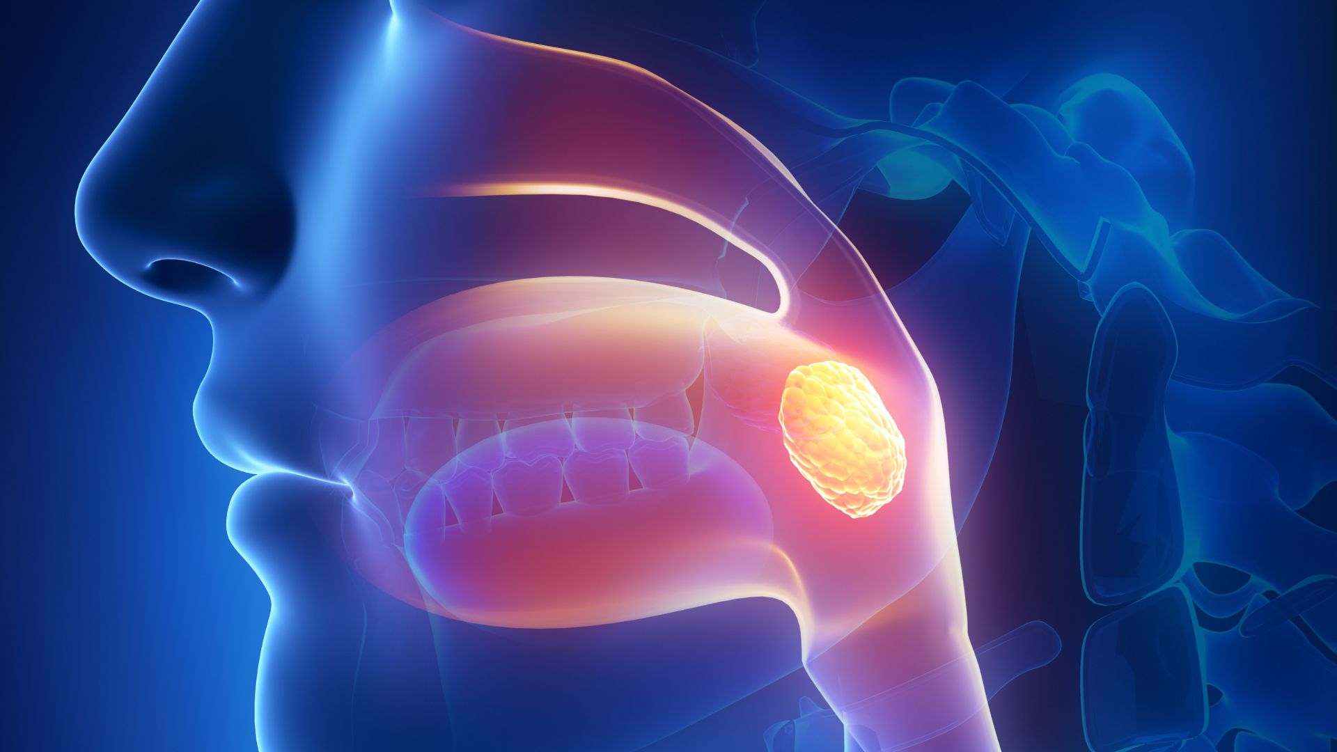 Ung thư amidan là một biến chứng của viêm amidan kéo dài