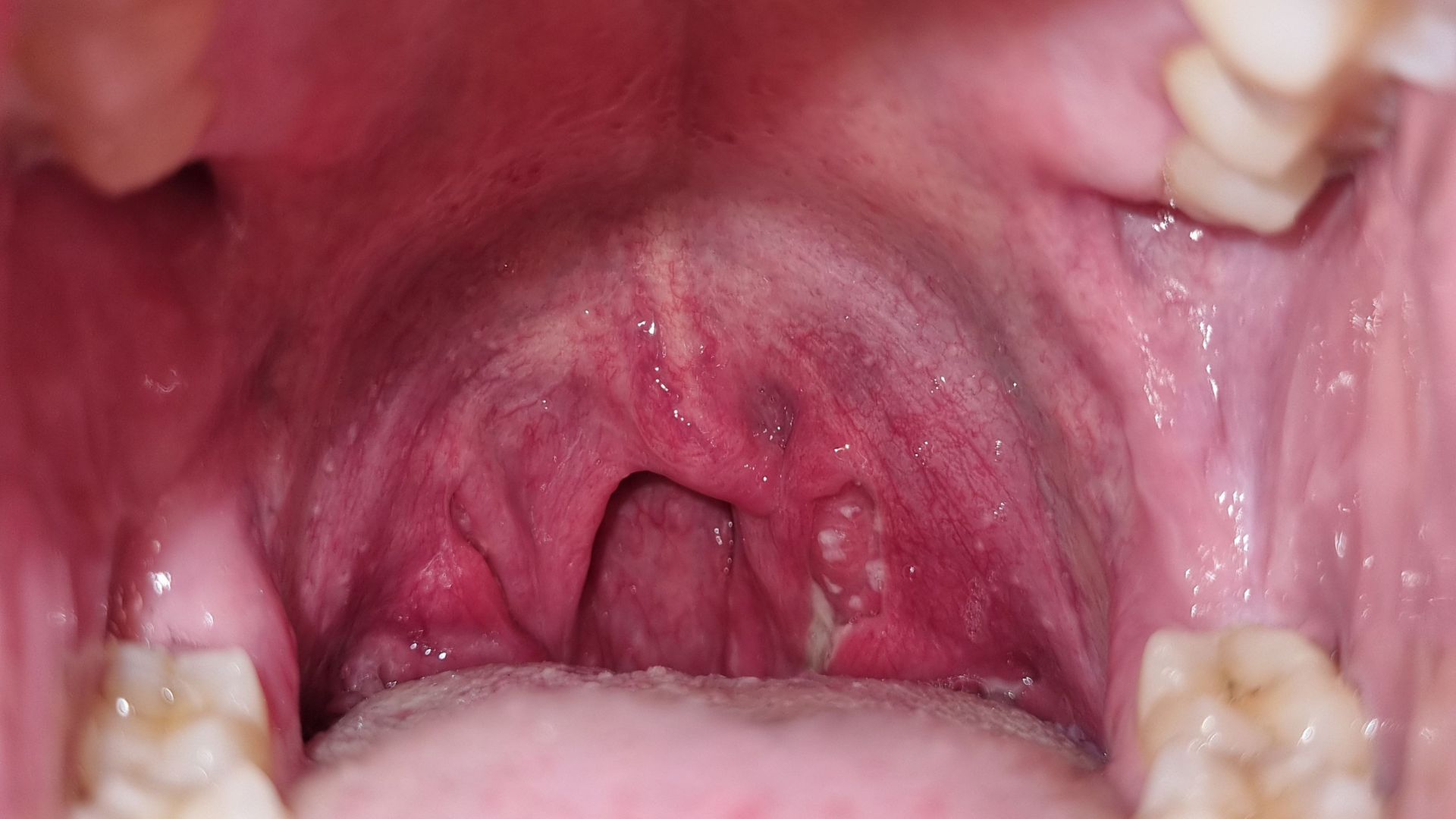 Viêm amidan hốc mủ có tự khỏi không