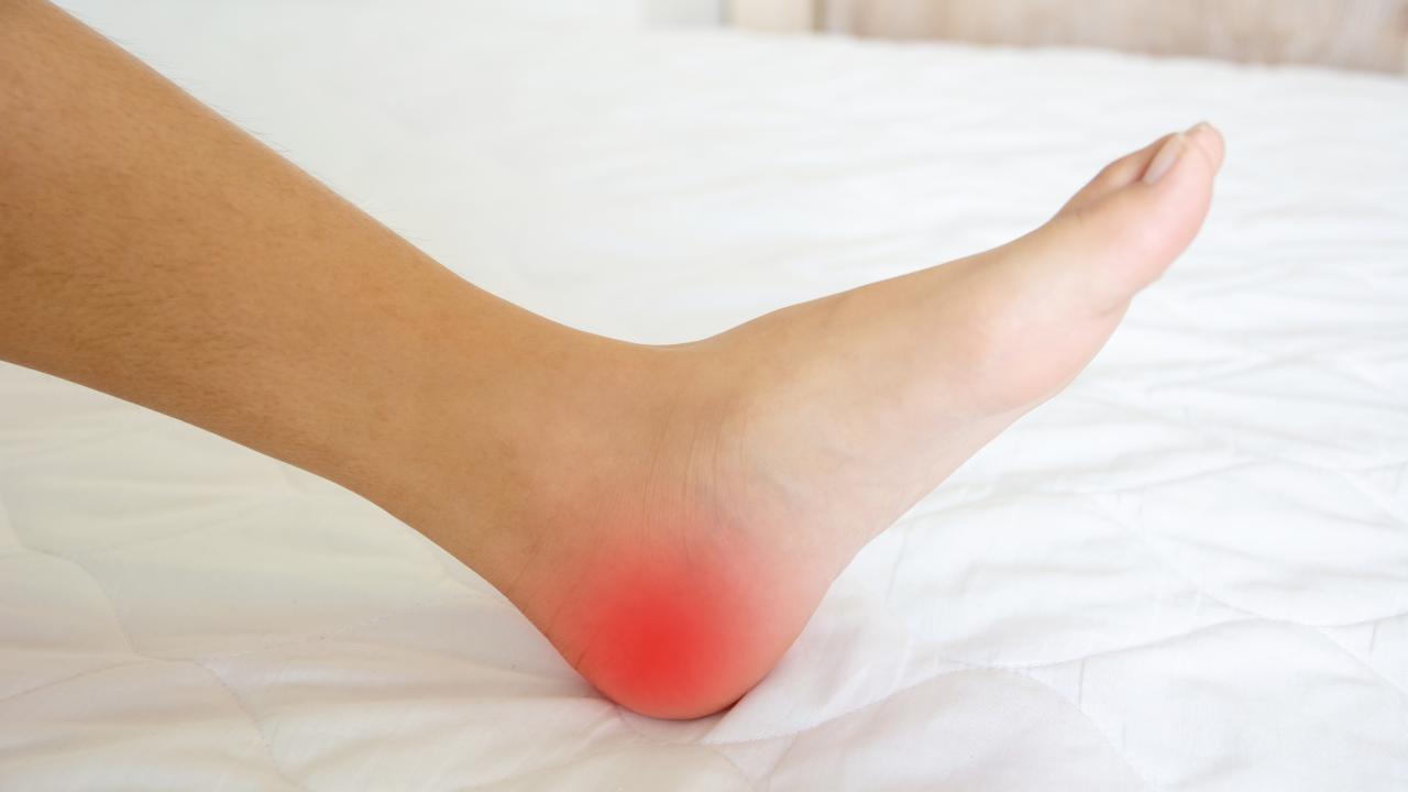 Tình trạng sưng tại gót chân, đôi khi lan ra bàn chân hoặc vùng mắt cá chân