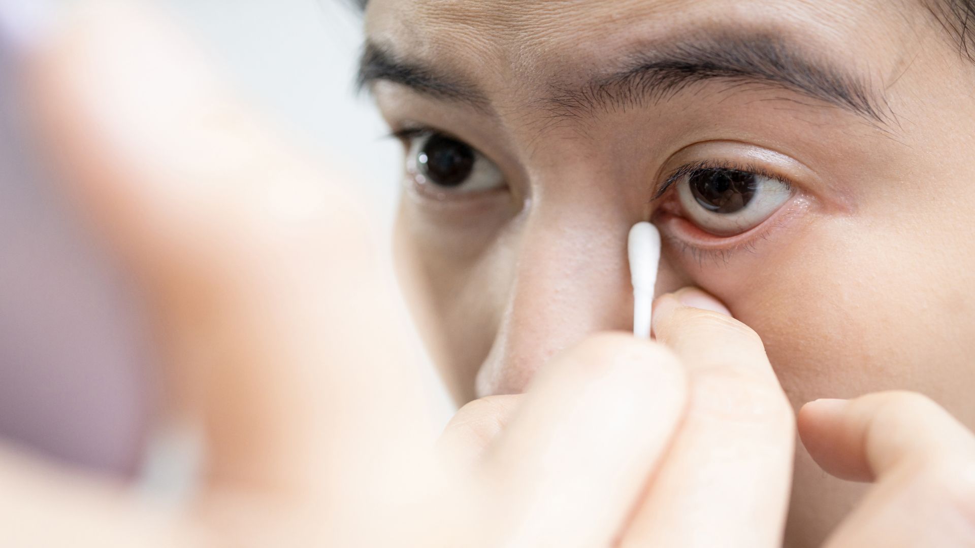 Để tránh lây nhiễm và ngăn tái phát, người bệnh cần vệ sinh mắt đúng cách và giữ thói quen sinh hoạt lành mạnh