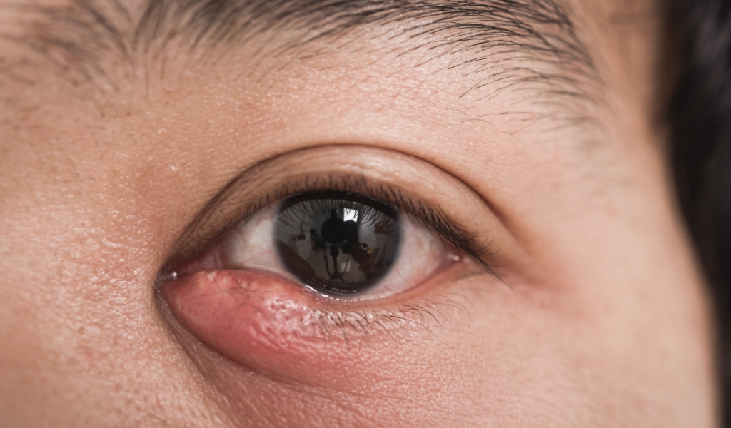 Viêm bờ mi dưới gây sưng đỏ, ngứa và chảy nước mắt nhiều