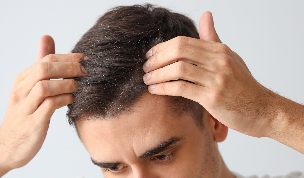 Gàu và viêm da tiết bã có thể gây bong vảy, rơi xuống mí mắt và dẫn đến viêm