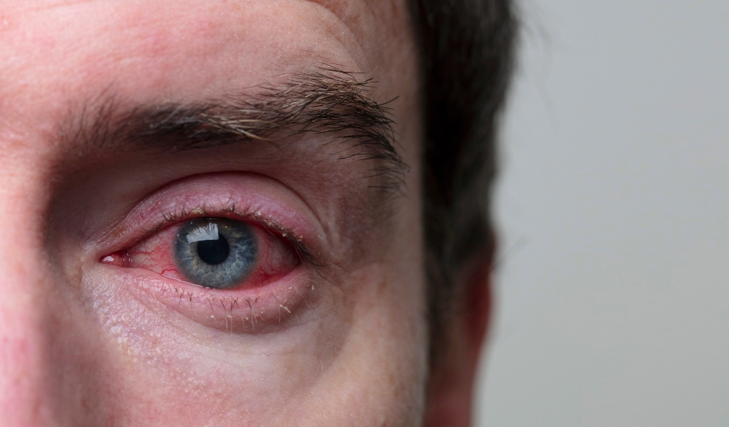 Viêm bờ mi kéo dài có thể dẫn đến tổn thương, nhiễm trùng giác mạc