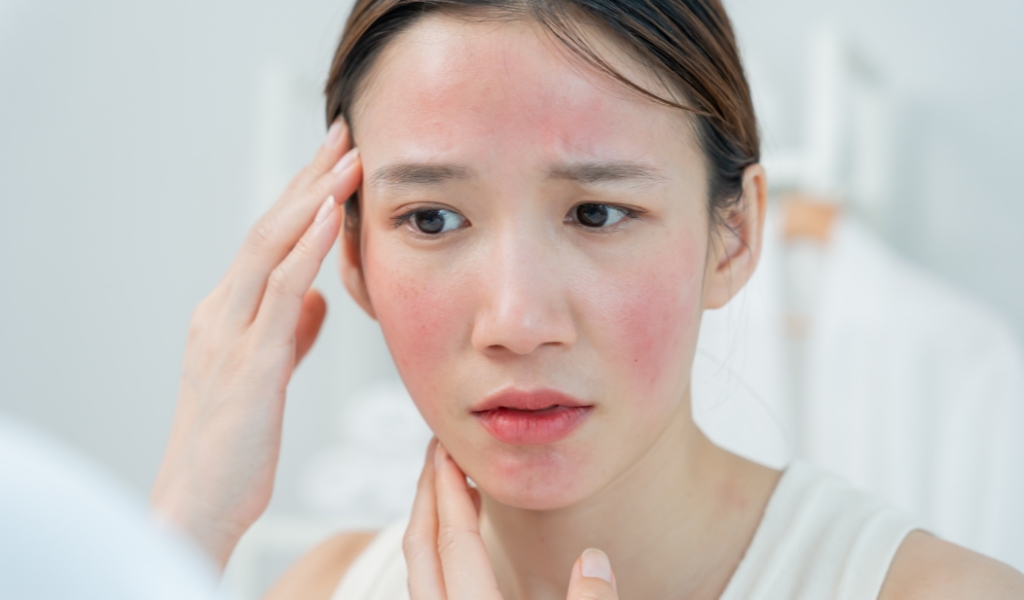 Viêm da, gàu hoặc mụn trứng cá đỏ có thể gây viêm và tắc tuyến nhờn ở mí mắt