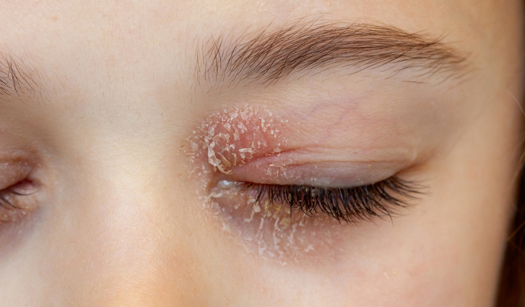 Sưng, ngứa, dính mí và vảy quanh gốc lông mi là các triệu chứng thường gặp