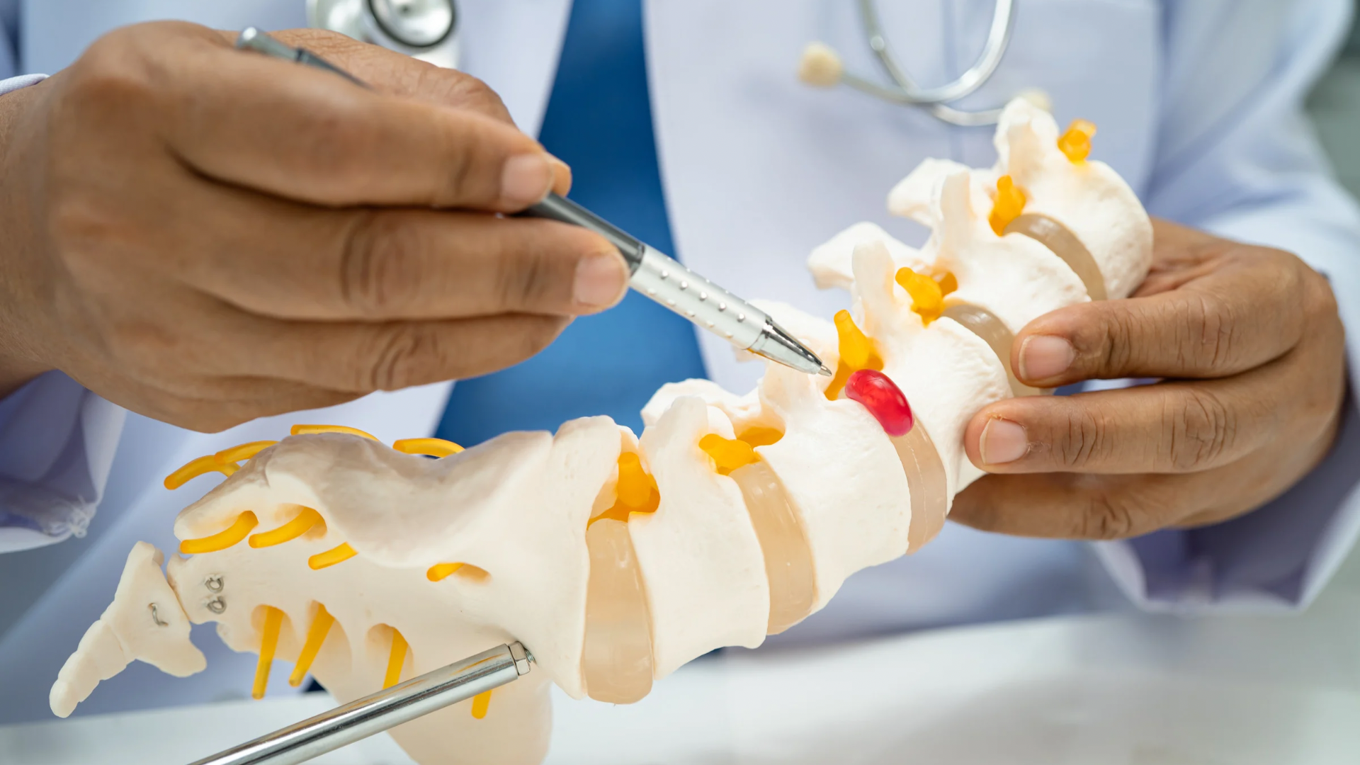 Viêm cột sống dính khớp là một bệnh lý chủ yếu ảnh hưởng đến cột sống và các khớp lớn