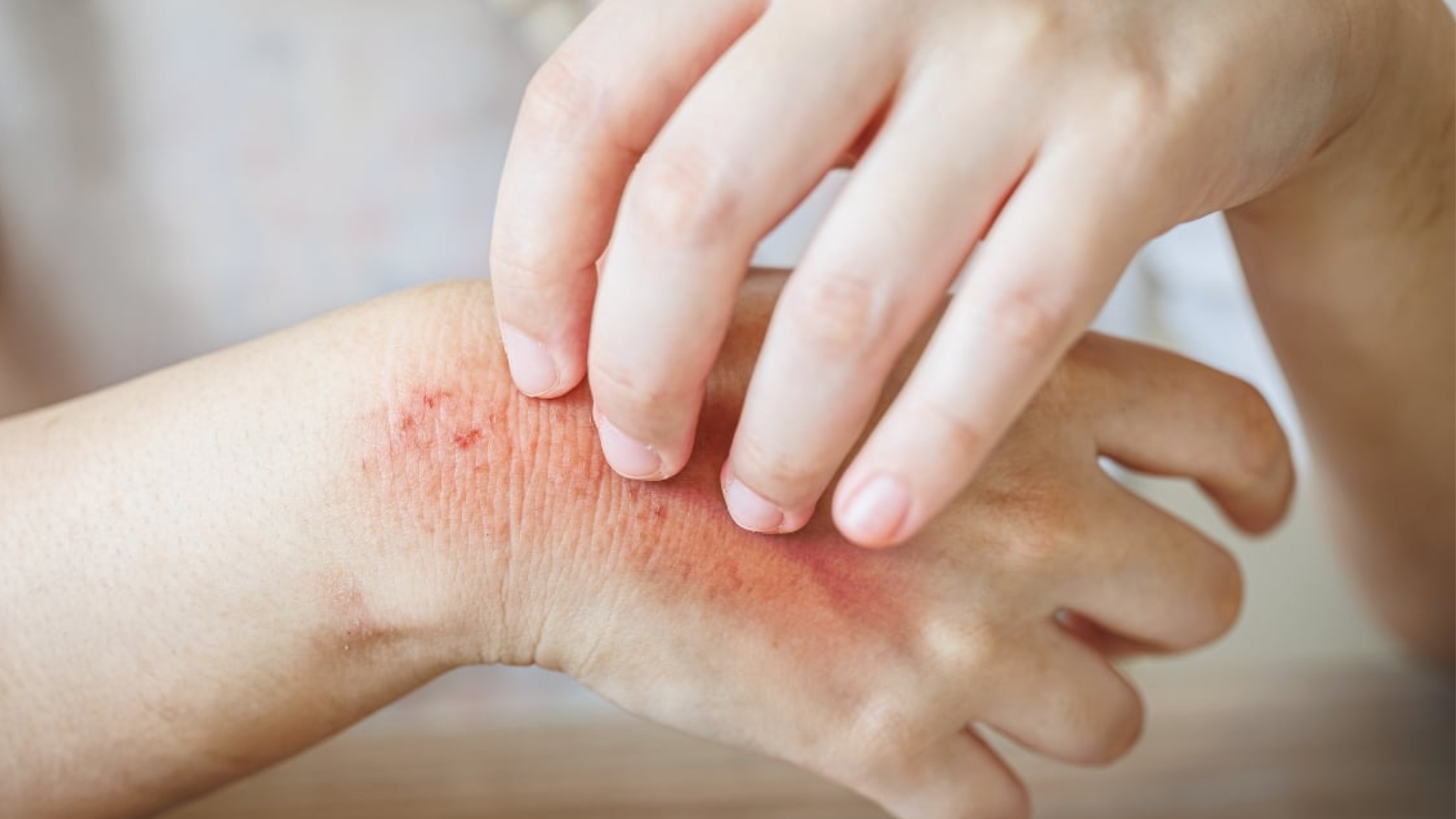 Viêm da cơ địa bội nhiễm khiến việc điều trị trở nên phức tạp hơn, da dễ tổn thương và để lại sẹo