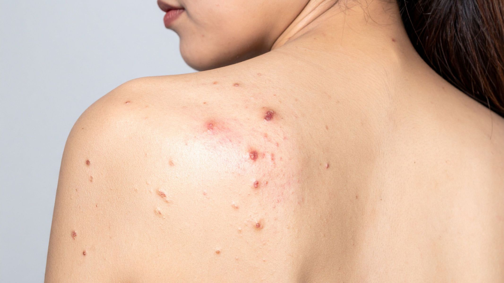 Viêm da cơ địa ở vùng lưng biểu hiện bằng các mụn nước nhỏ, nông trên nền da viêm đỏ