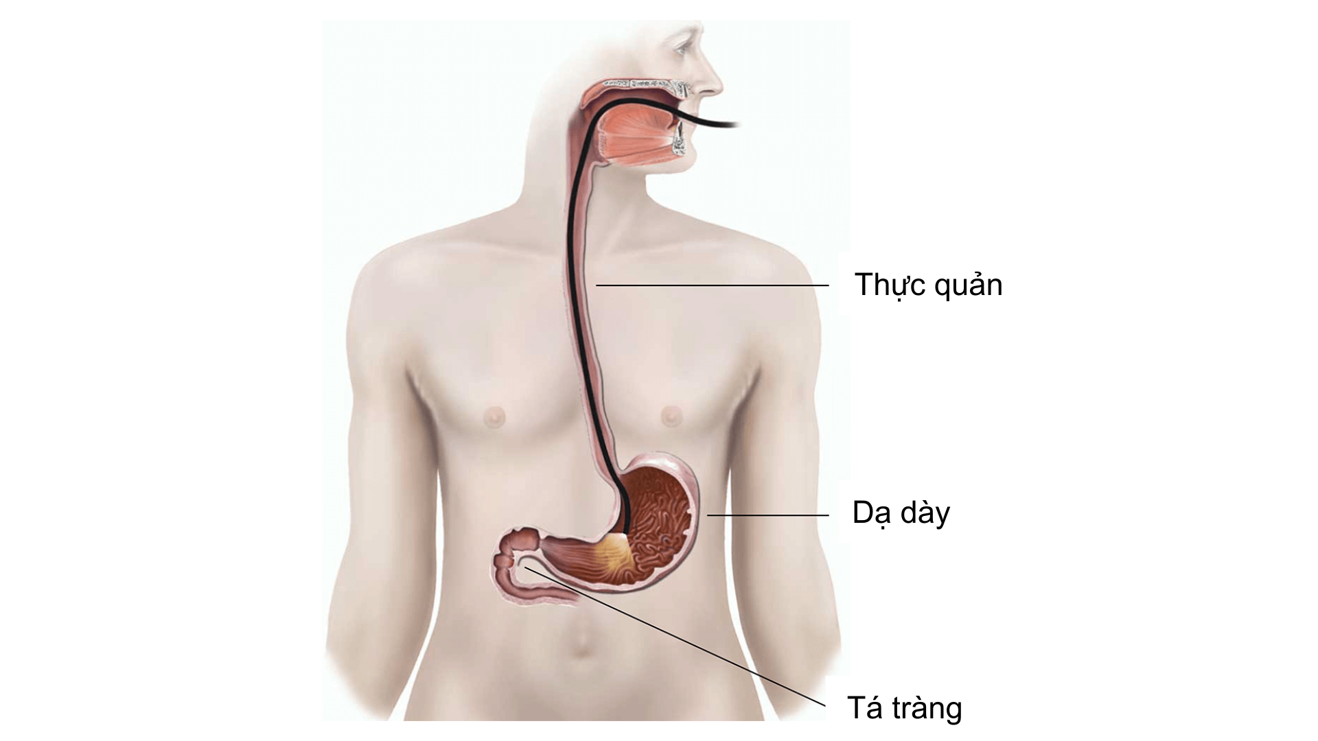 Viêm dạ dày: Nguyên nhân, triệu chứng và phương pháp điều trị 5