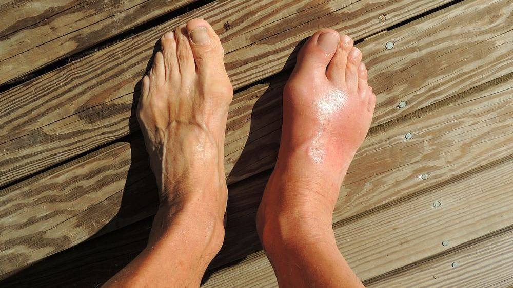 Viêm đa khớp do gout có thể được kiểm soát tốt dù không chữa khỏi hoàn toàn