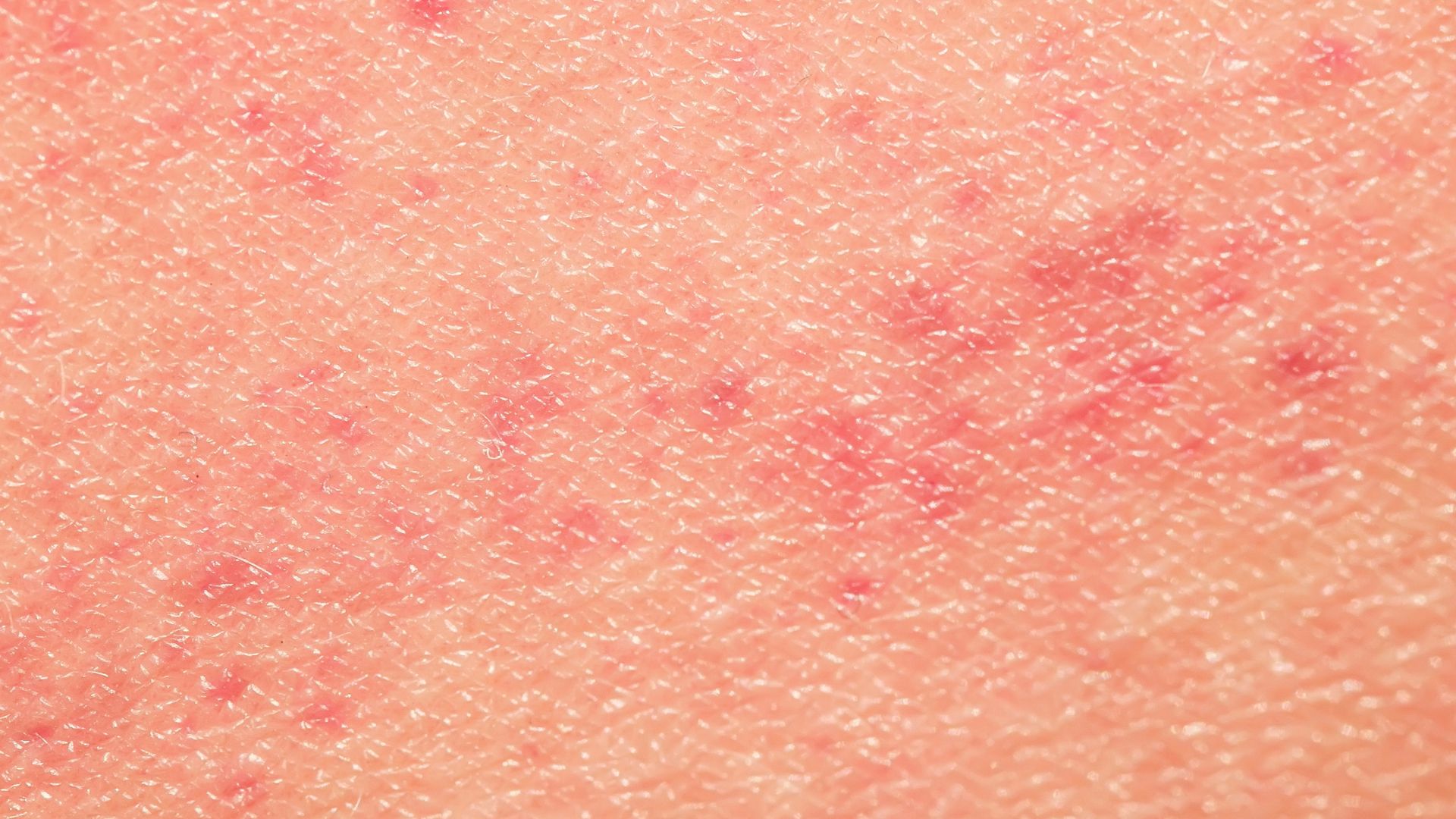 Vùng da nhiễm liên cầu khuẩn thường đỏ nhẹ ở giai đoạn đầu