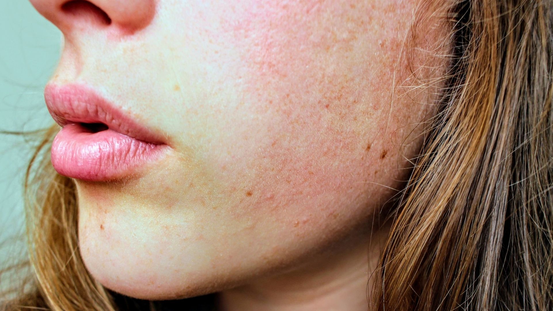 Viêm da tiếp xúc có thể gây khô da