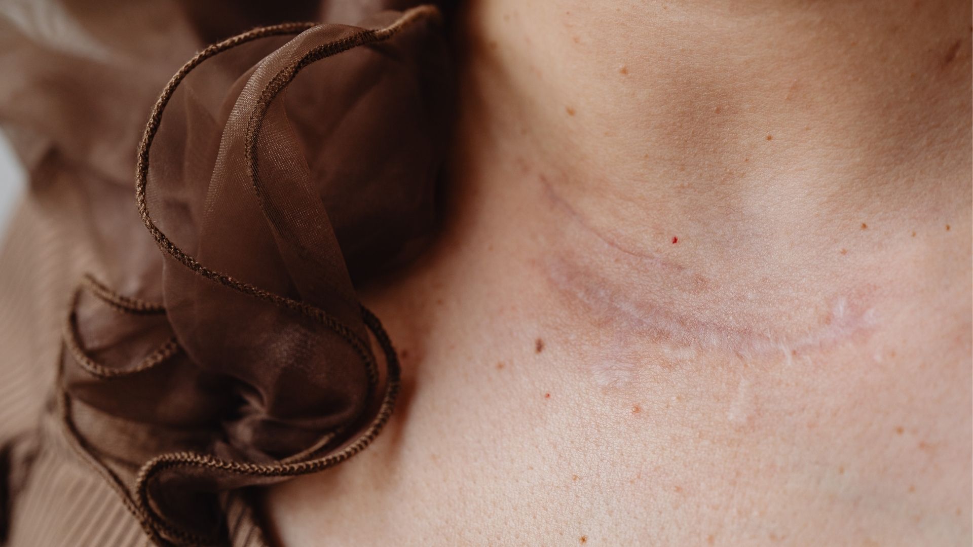 Tổn thương da làm tăng nguy cơ xuất hiện viêm da tiếp xúc