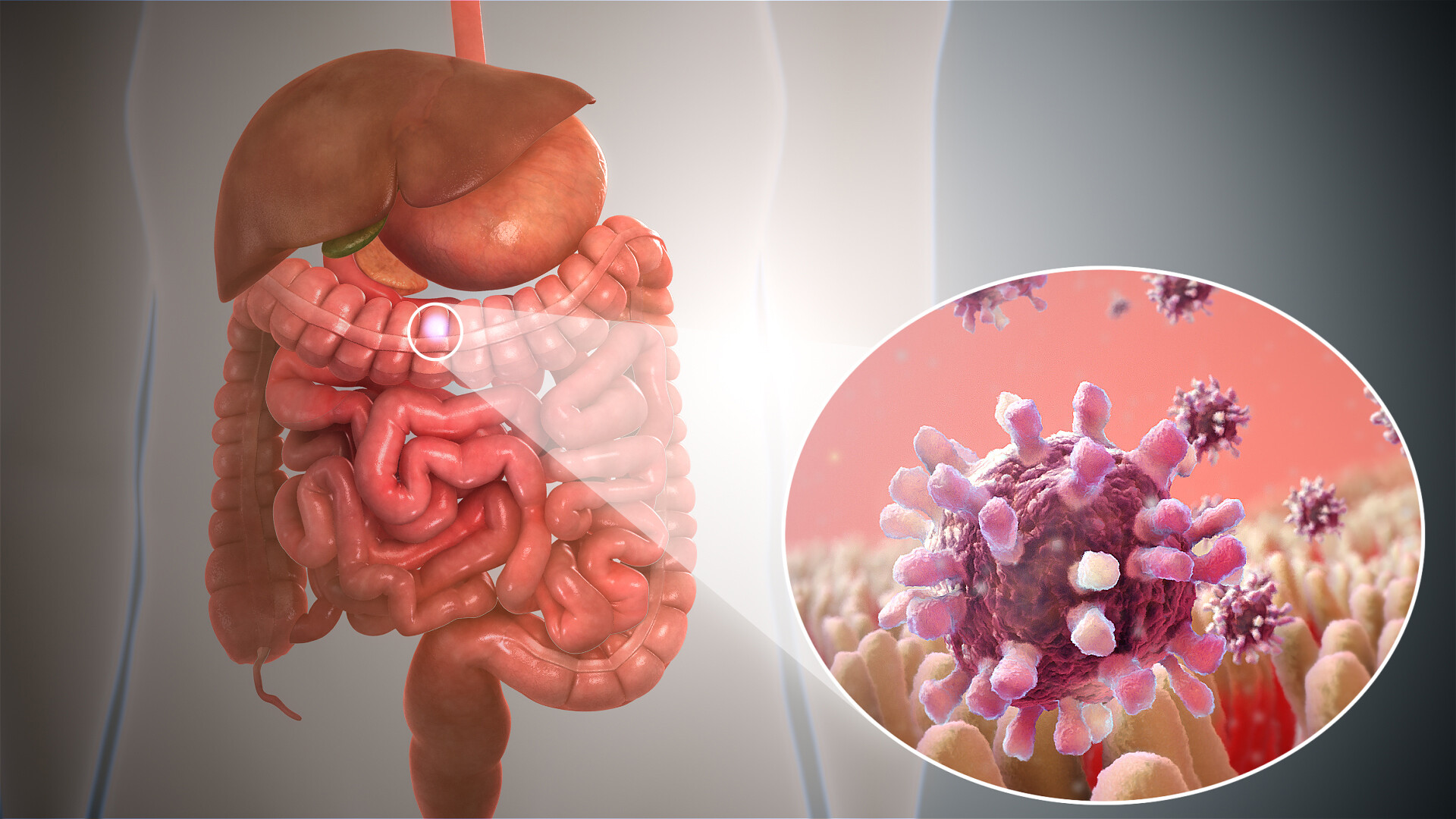 Nguyên nhân chủ yếu gây viêm đại tràng mạn tính là do nhiễm vi khuẩn hoặc virus hoặc ký sinh trùng