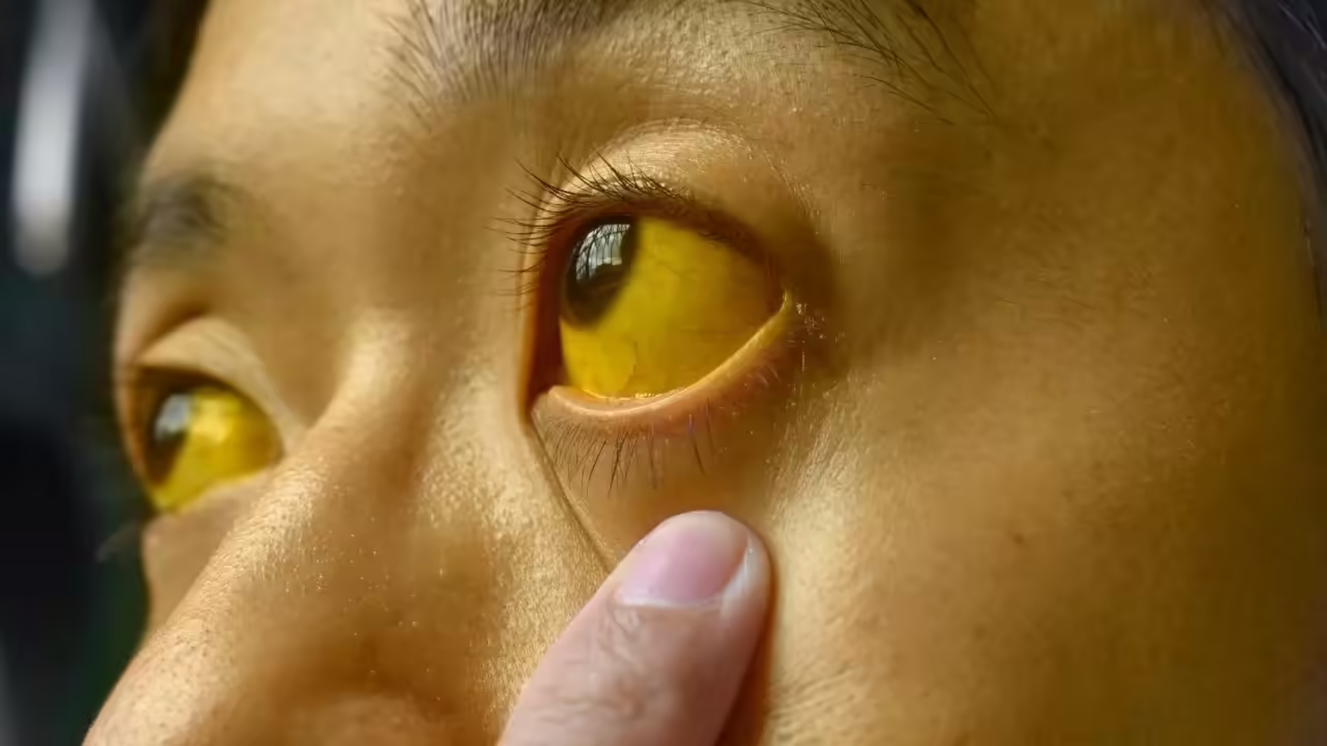 Viêm đường mật: Nguyên nhân, triệu chứng và điều trị 1