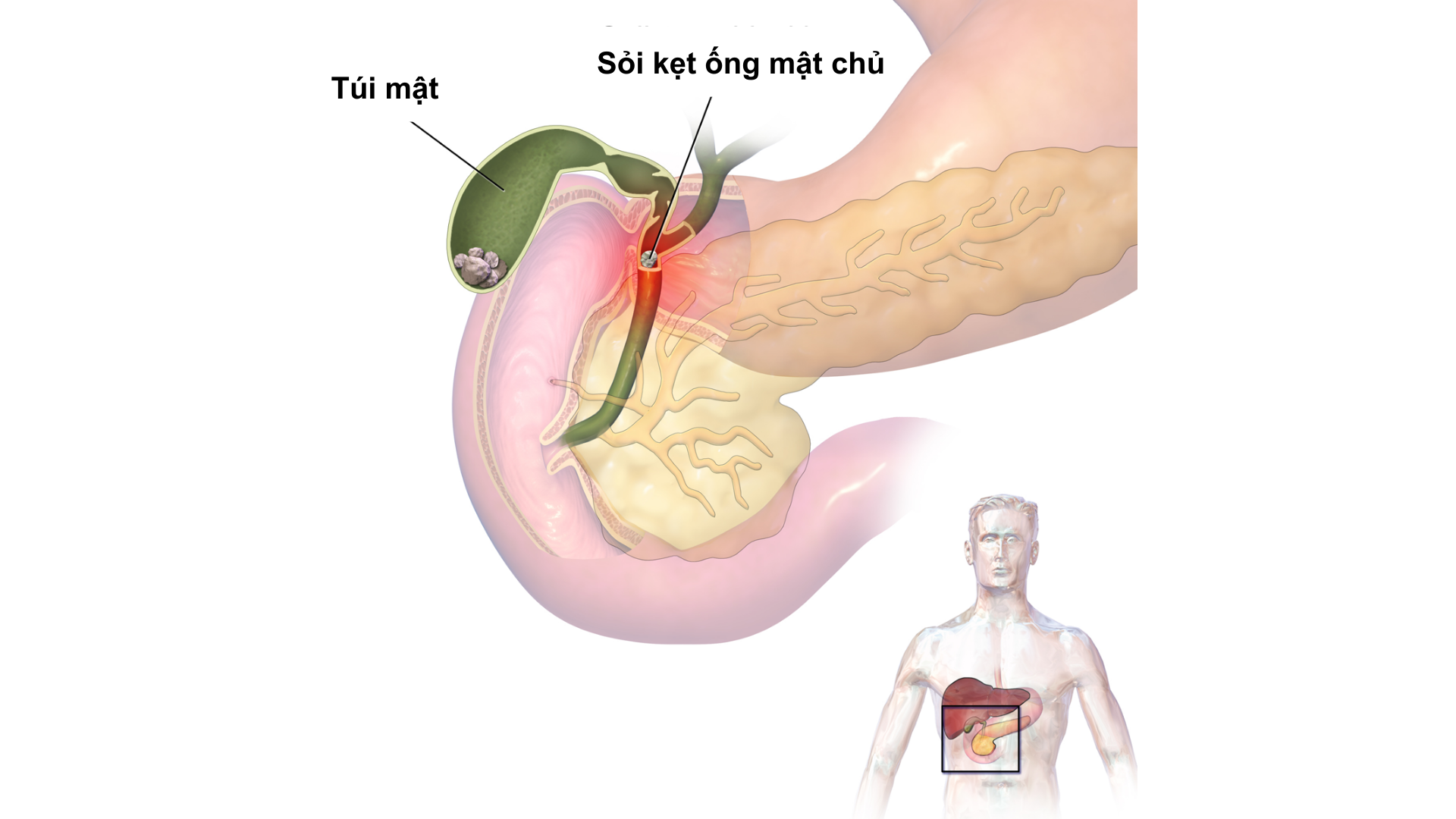 Viêm đường mật: Nguyên nhân, triệu chứng và điều trị 4