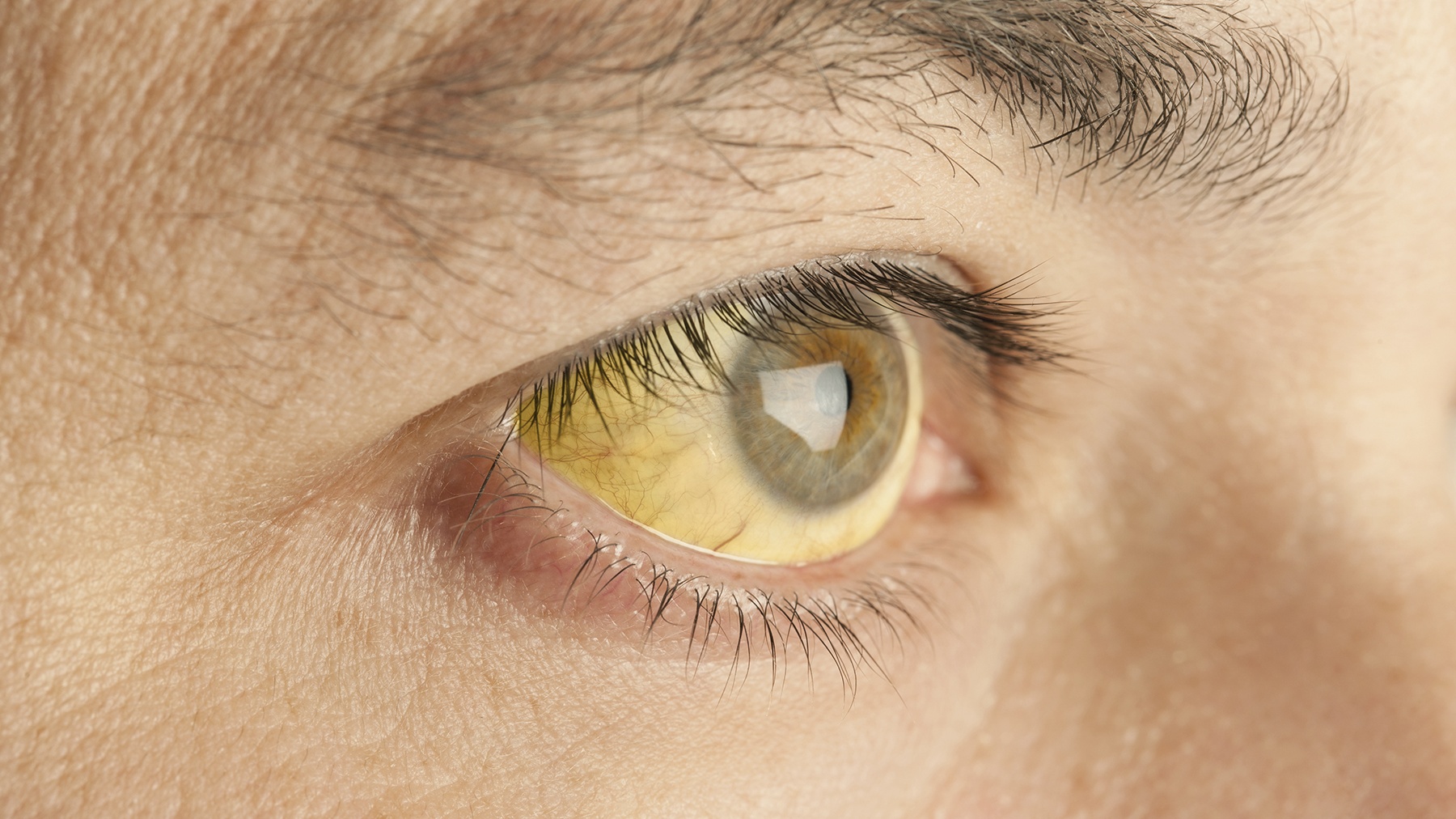 Vàng da, vàng mắt có thể xuất hiện khi bị nhiễm viêm gan E