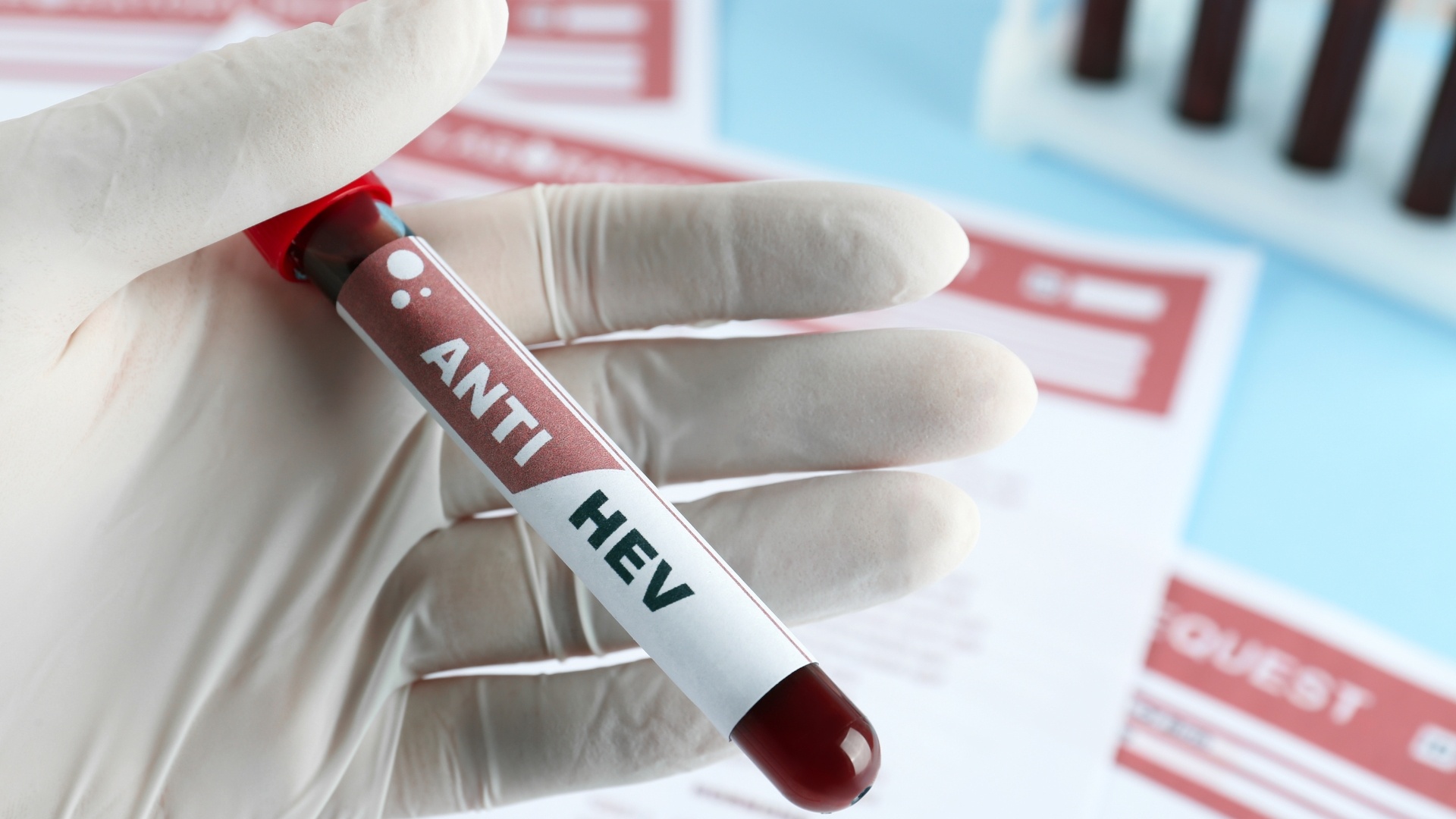 Viêm gan E chỉ có thể được chẩn đoán bằng xét nghiệm