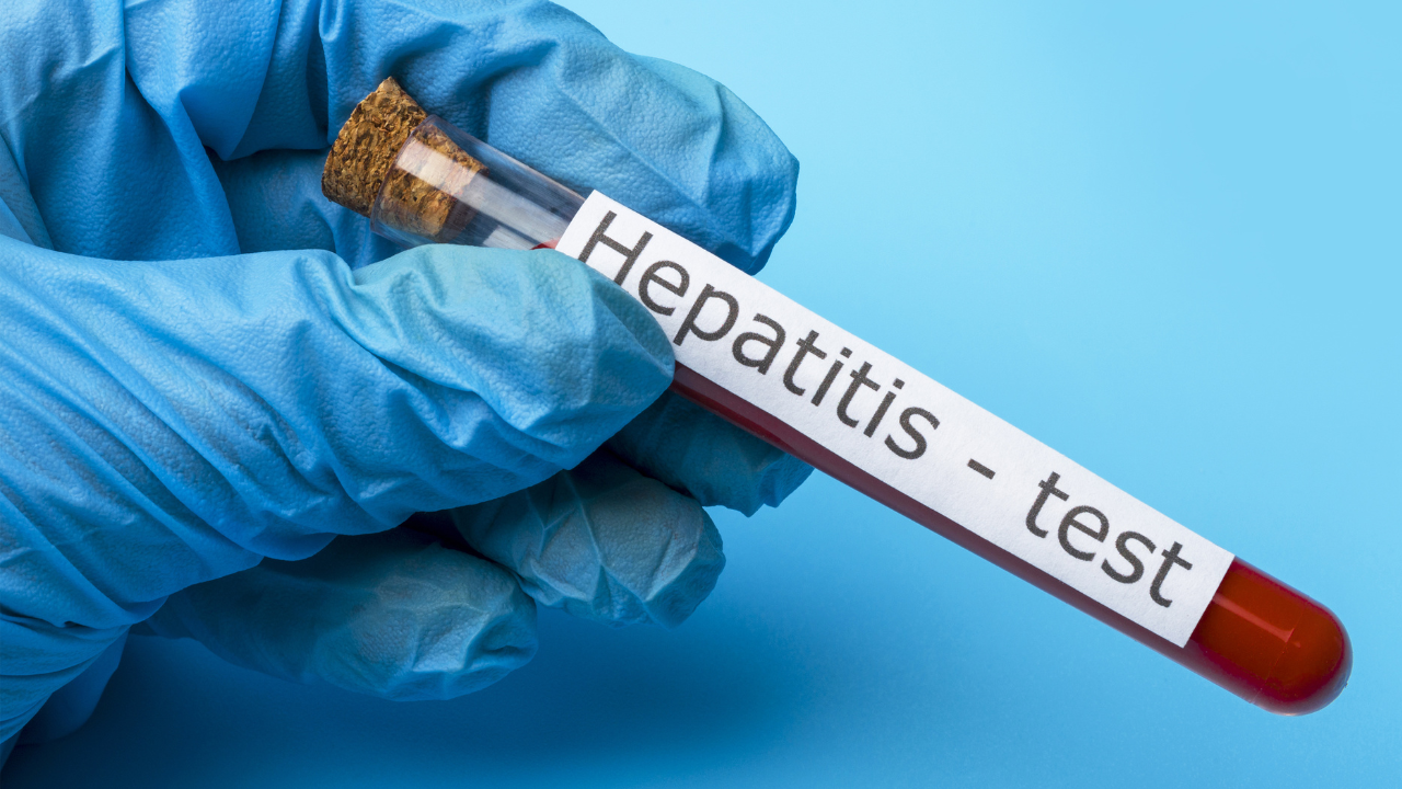 Phân biệt viêm gan và xơ gan qua xét nghiệm máu