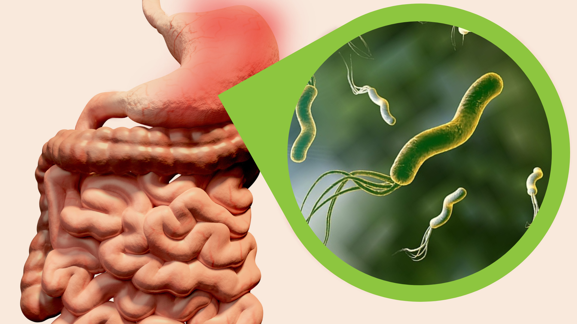 Viêm hang vị dạ dày: Nguyên nhân, triệu chứng và điều trị 2