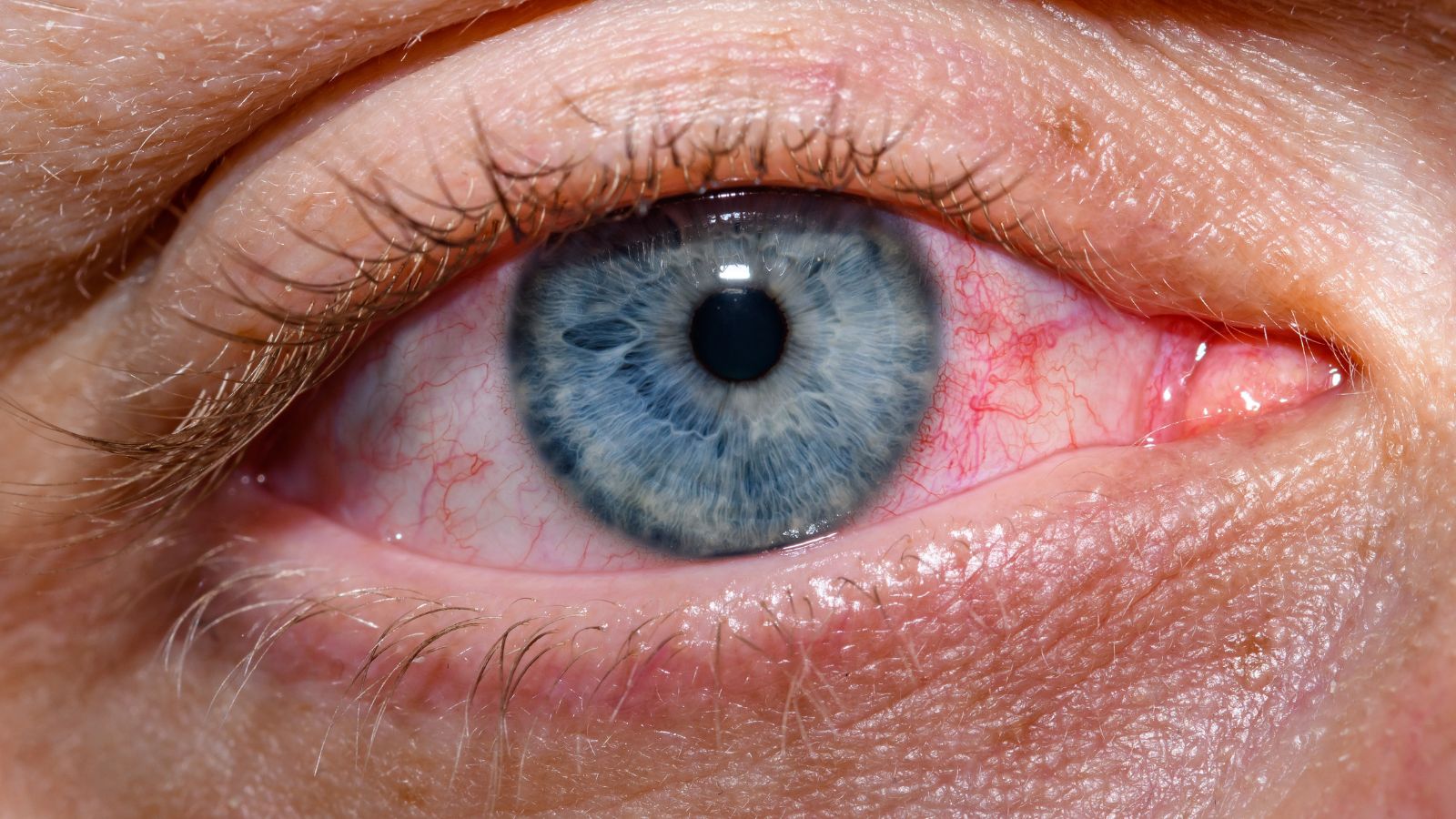 Viêm kết giác mạc cấp là tình trạng viêm xảy ra đồng thời ở kết mạc và giác mạc