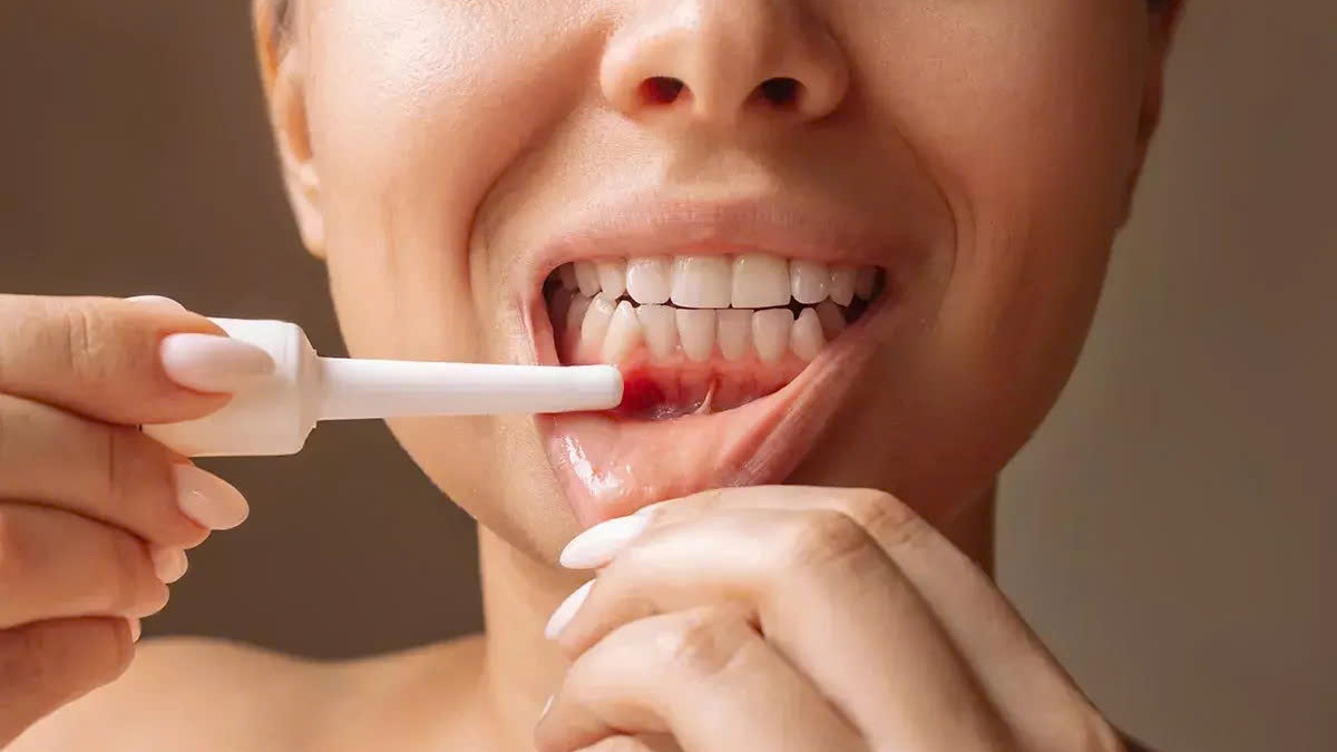 Sử dụng thuốc không kê đơn cho các vết loét phổ biến như nhiệt miệng