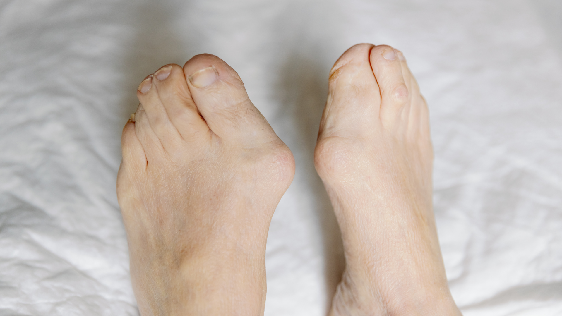 Nếu không thăm khám và điều trị thích hợp, viêm khớp có thể dẫn đến biến dạng khớp