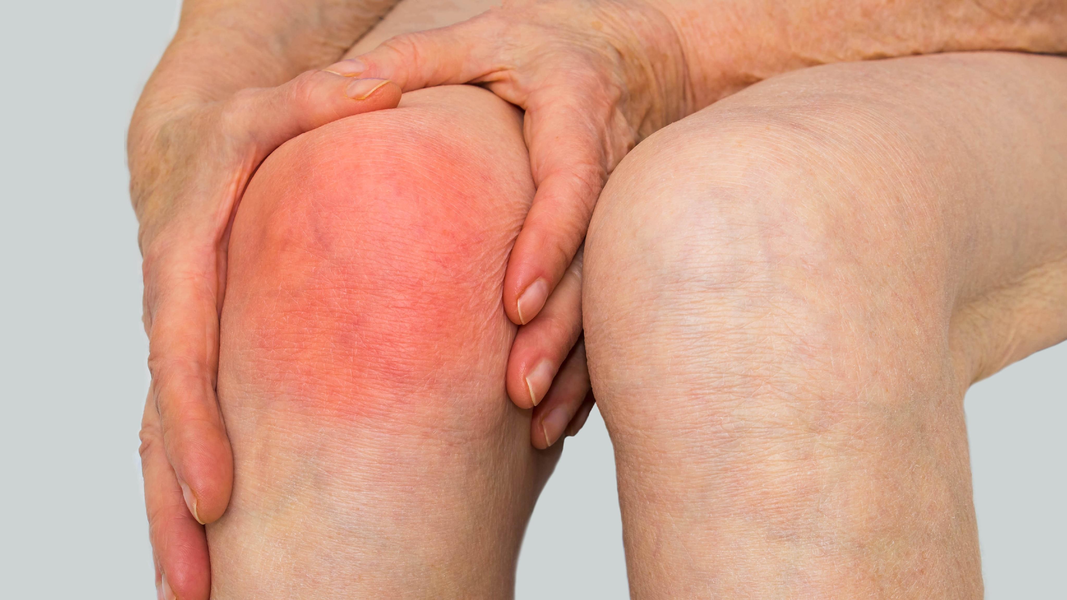 Viêm khớp nhiễm khuẩn là gì? Nguyên nhân, triệu chứng và cách điều trị 1.jpg