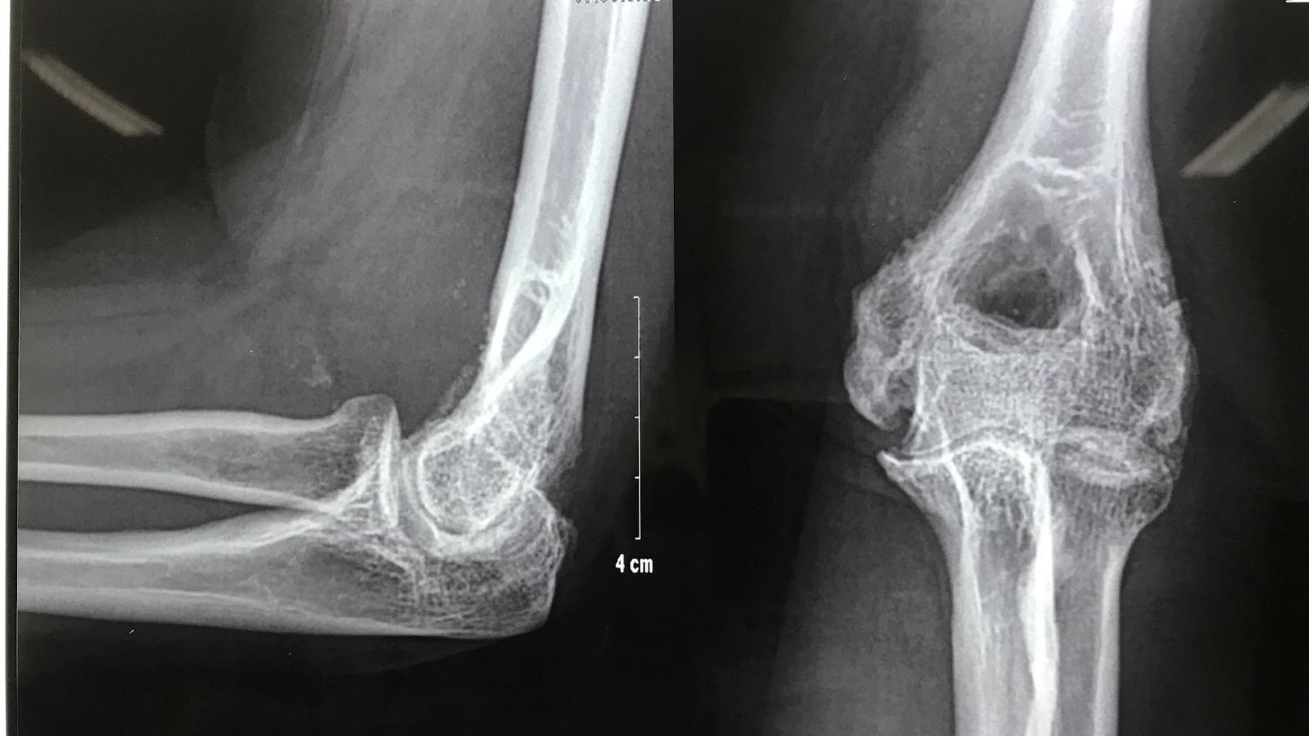 Viêm khớp nhiễm khuẩn là gì? Nguyên nhân, triệu chứng và cách điều trị 4.jpg