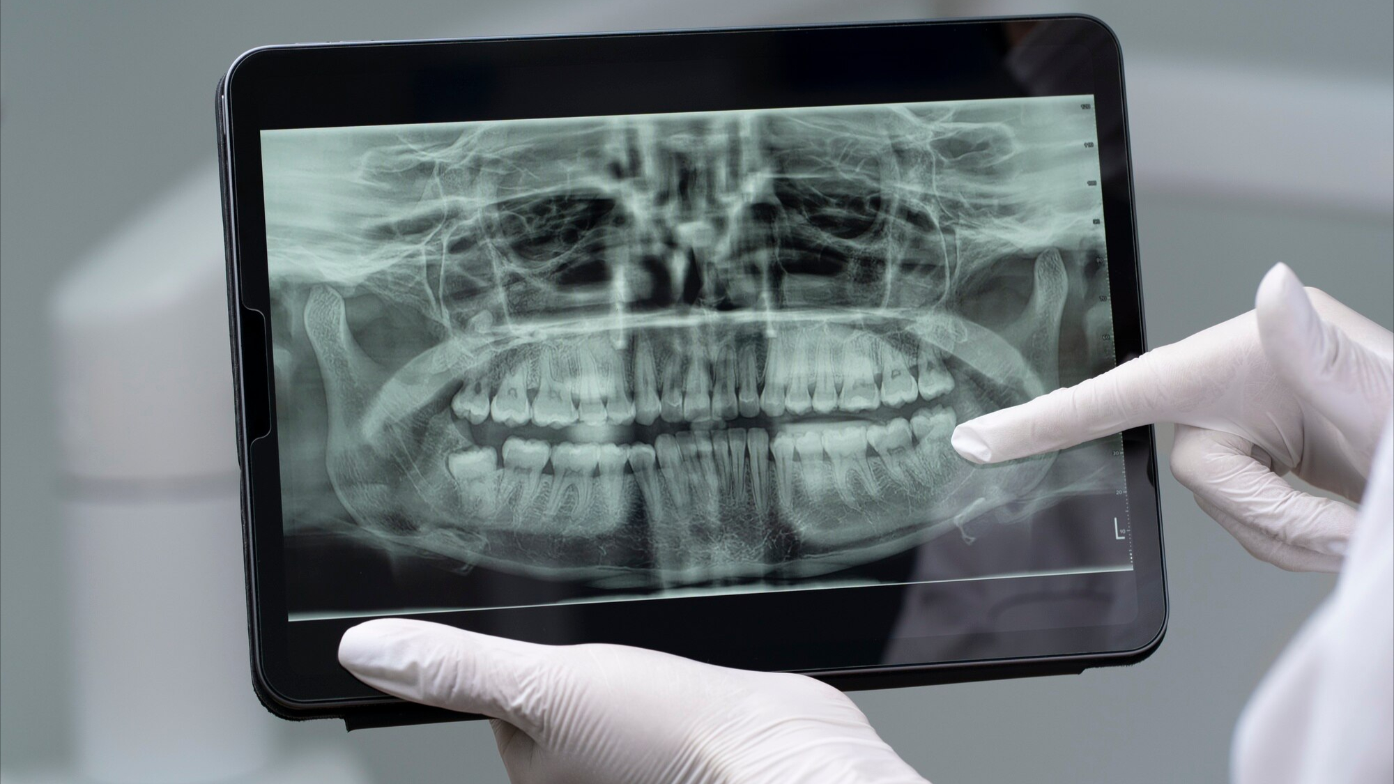 viem-khop-thai-duong-ham 6.jpeg