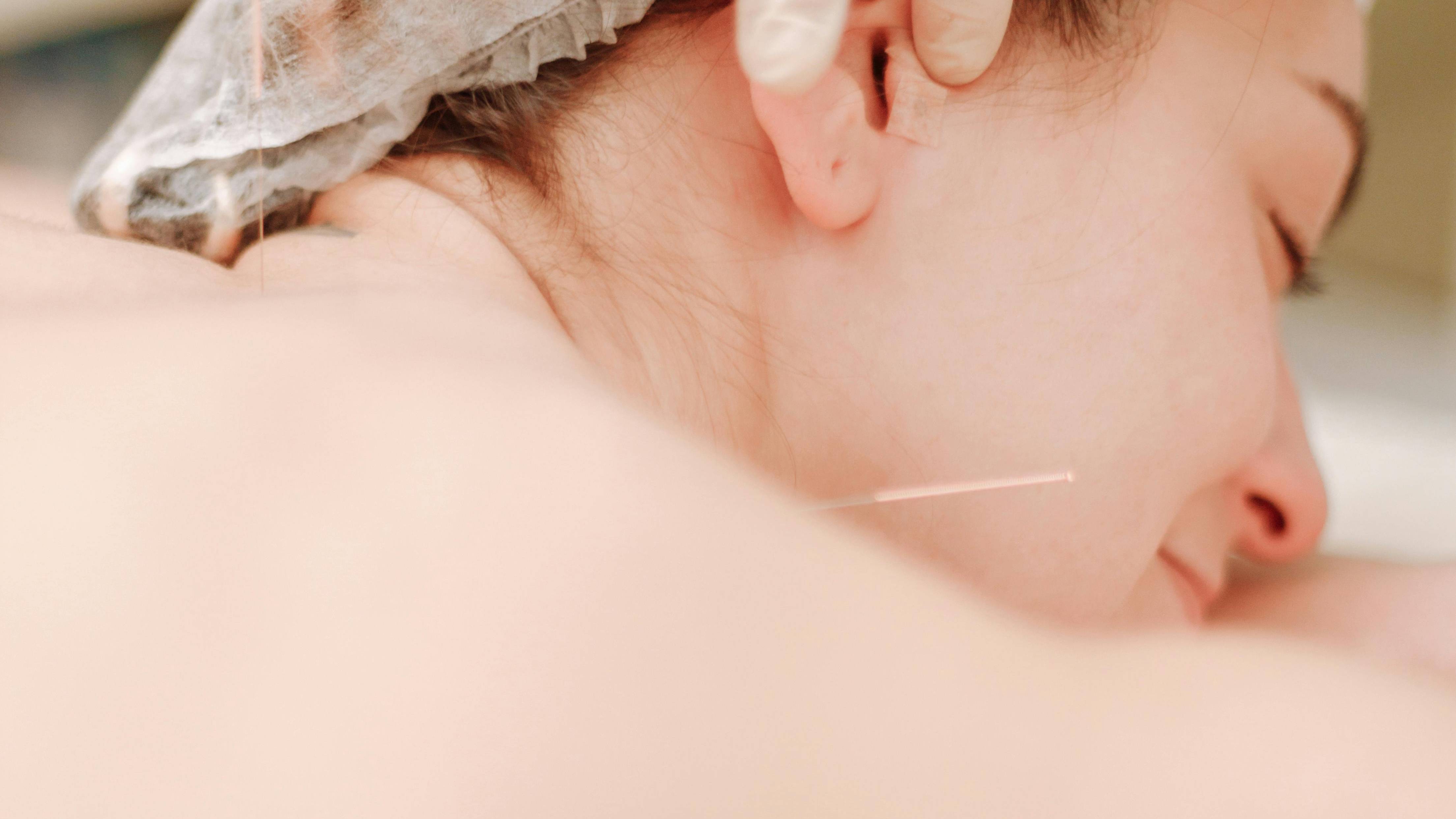 Điều trị bằng châm cứu thường được áp dụng hỗ trợ điều trị, mang lại hiệu quả cao