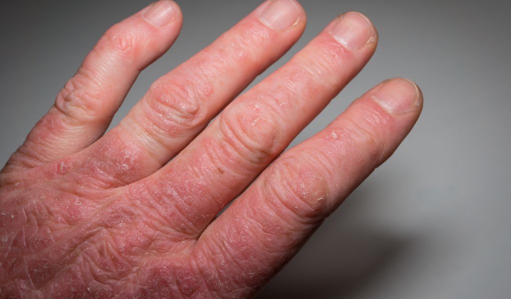 Viêm khớp vảy nến với các tổn thương đặc trưng ở khớp và da
