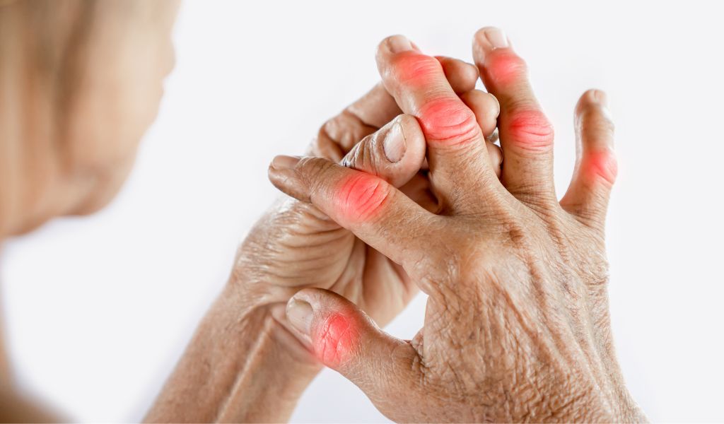Bệnh gây sưng đau, cứng khớp, thường gặp ở ngón tay, ngón chân