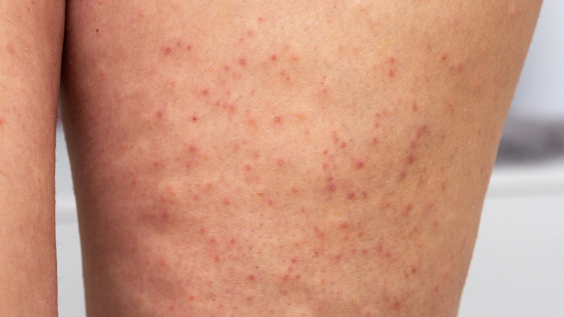 Viêm lỗ chân lông ở chân là tình trạng viêm nhiễm xảy ra tại nang lông do sự xâm nhập của vi khuẩn, nấm hoặc bít tắc lỗ chân lông bởi bã nhờn và tế bào chết