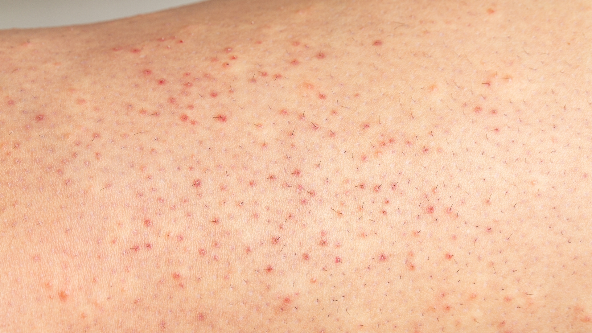 Các vi sinh vật, đặc biệt là vi khuẩn tụ cầu hoặc một số loại nấm, có thể xâm nhập vào nang lông khi hàng rào bảo vệ da bị suy yếu