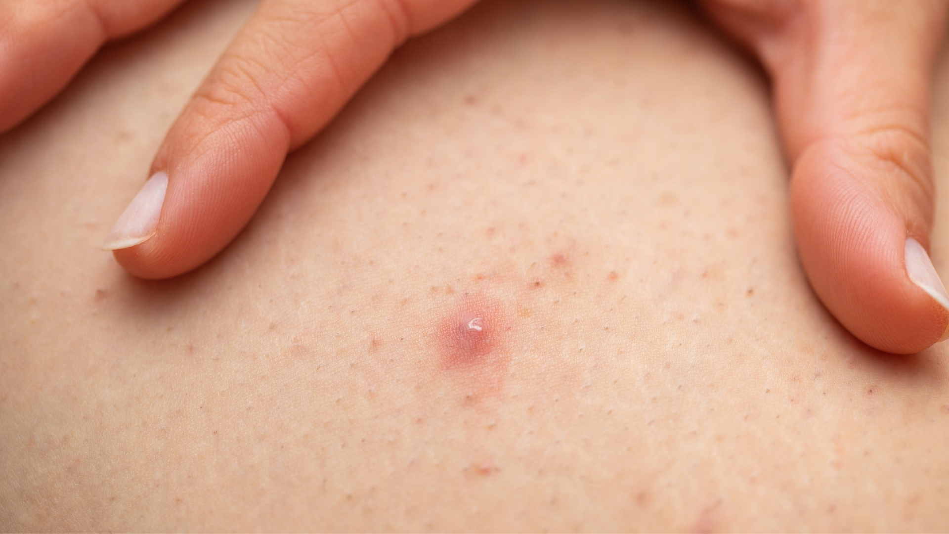 Một số người có cơ địa da nhạy cảm, dễ kích ứng sẽ có nguy cơ cao bị viêm lỗ chân lông ở chân