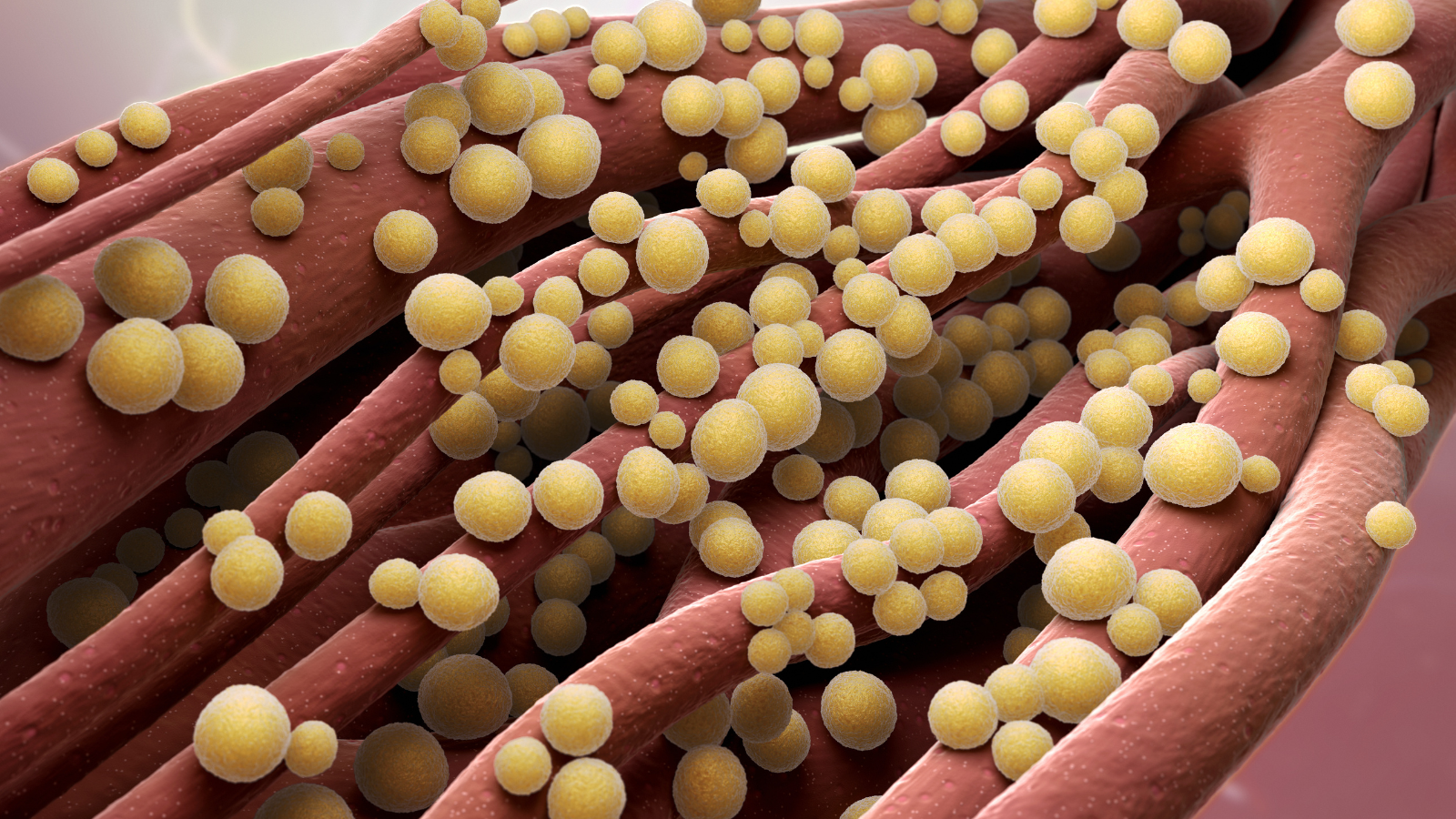 Một trong những nguyên nhân phổ biến nhất là Staphylococcus aureus